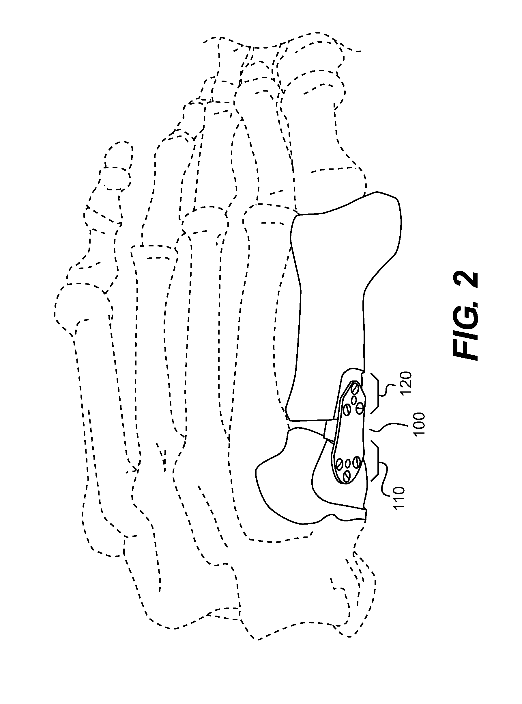 Implant for correcting skeletal mechanics