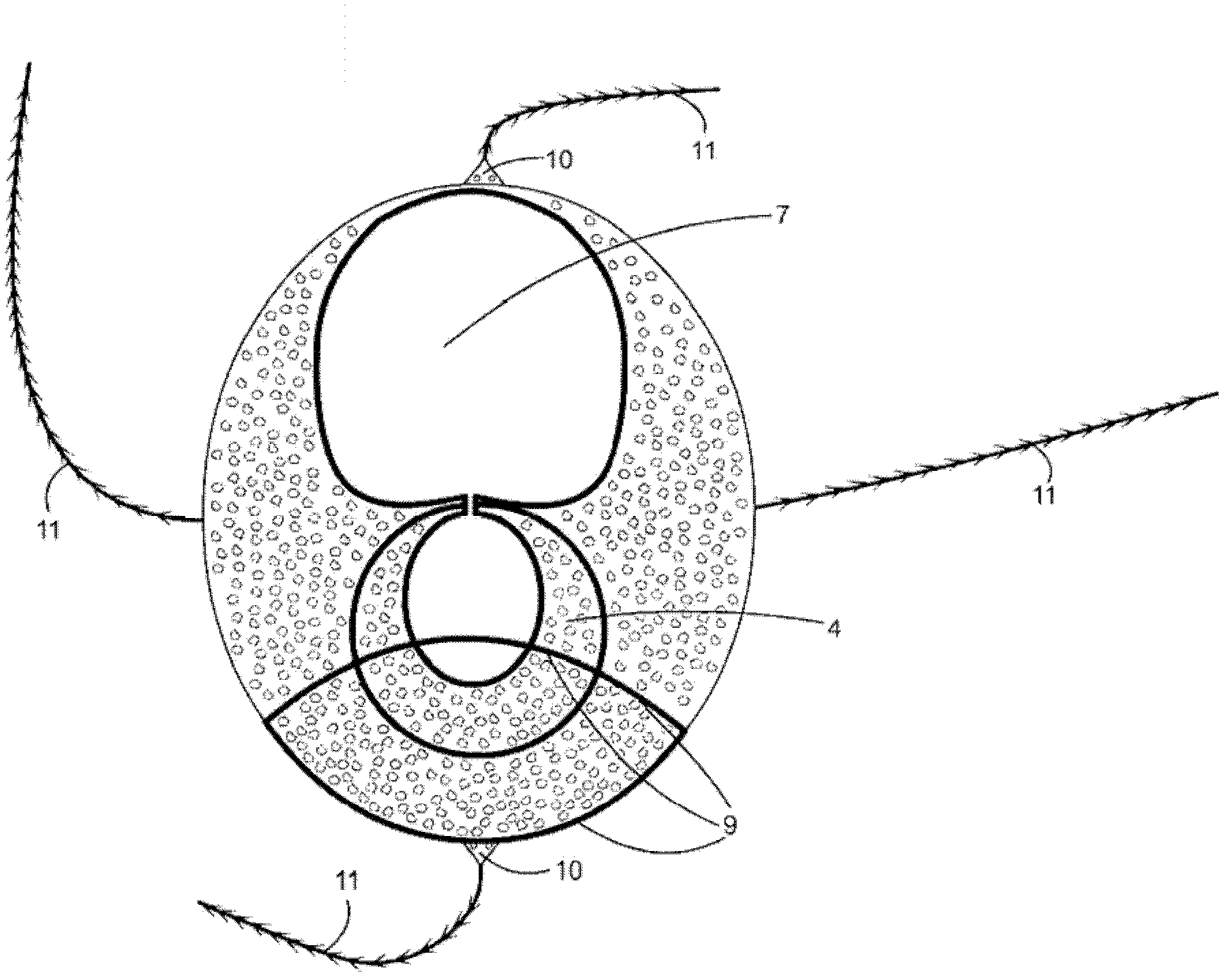 Silicon implant with expandable and/or interactive compartments, optionally coated with a ricinus communis and/or hydroxylapatite polyurethane foam, with attachment flaps or strings