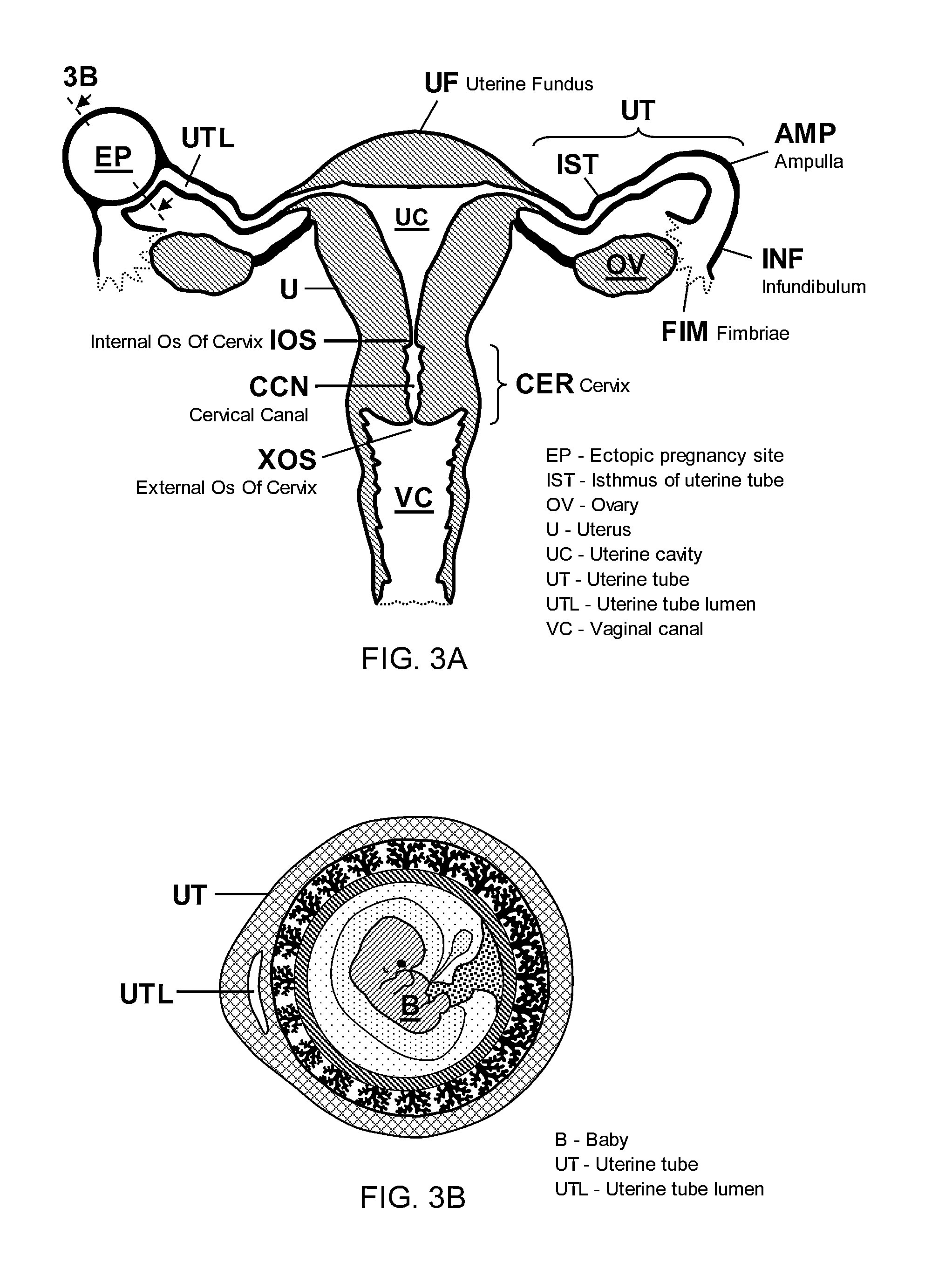 Nondestructive means of ectopic pregnancy management