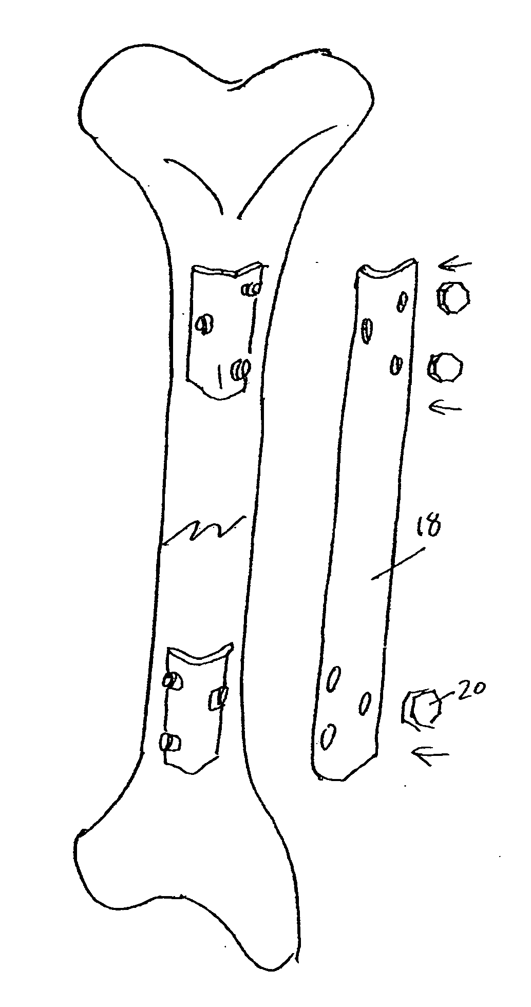 Lateral implant system and apparatus for reduction and reconstruction