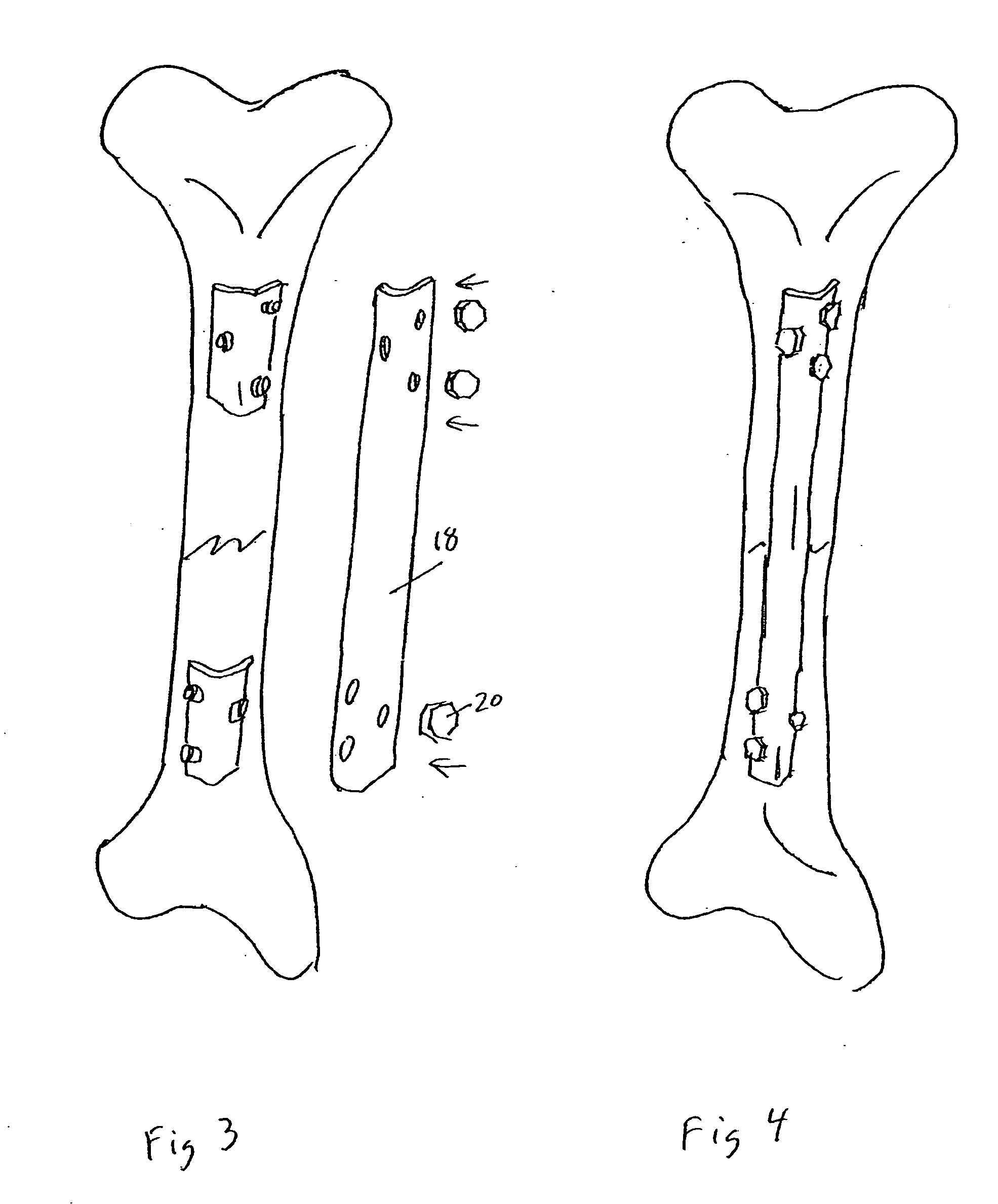 Lateral implant system and apparatus for reduction and reconstruction