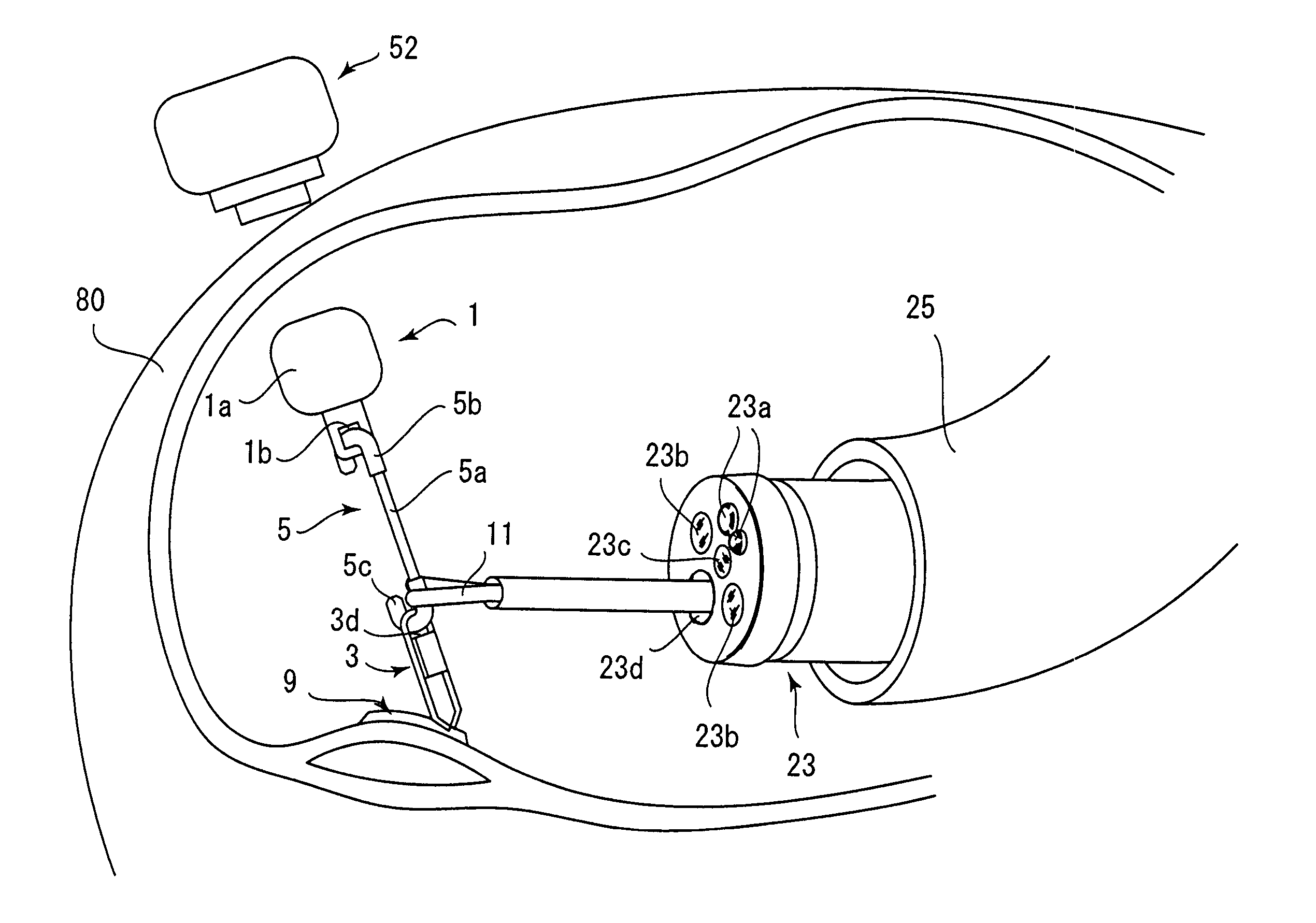 Magnetic anchor remote guidance system