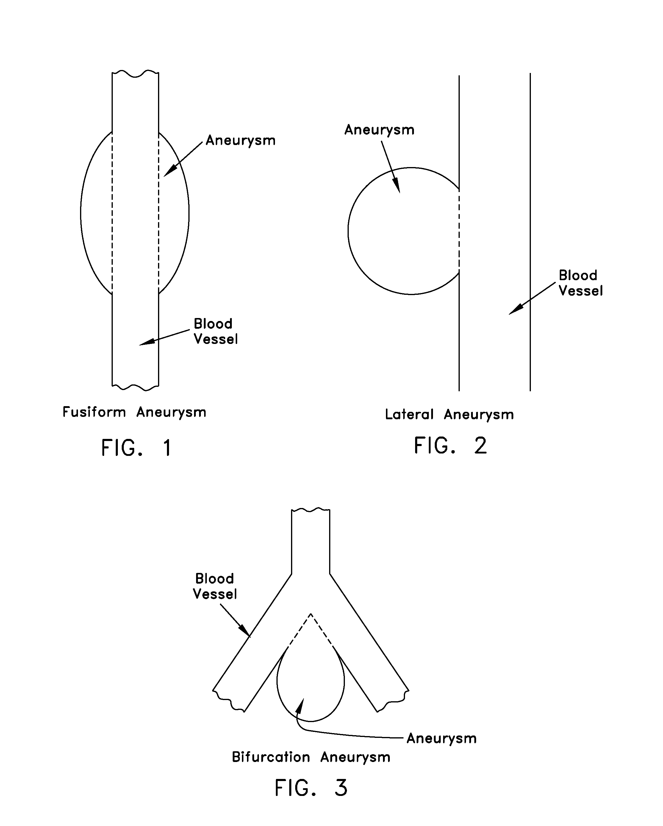 Method and apparatus for restricting flow through an opening in the side wall of a body lumen, and/or for reinforcing a weakness in the side wall of a body lumen, while still maintaining substantially normal flow through the body lumen