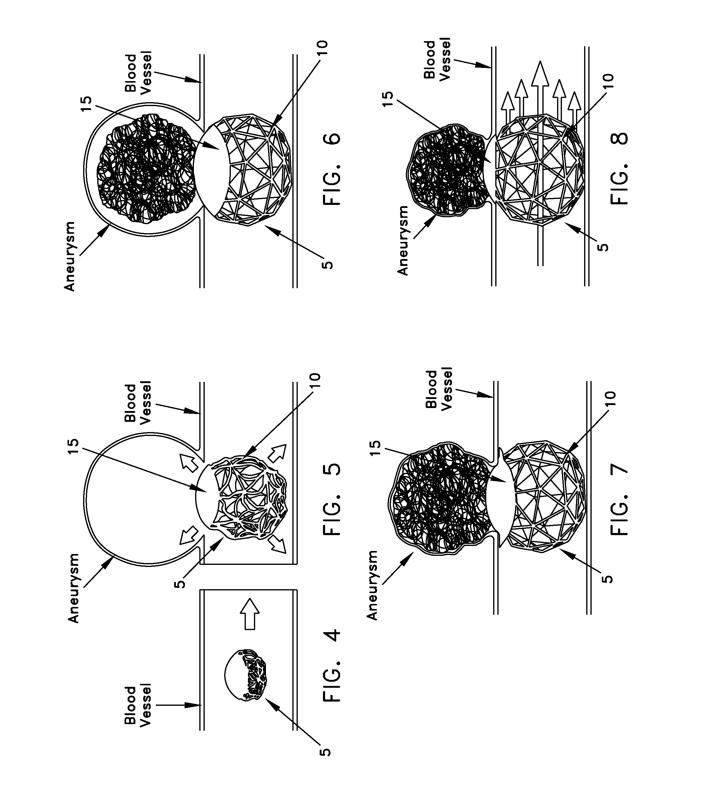 Method and apparatus for restricting flow through an opening in the side wall of a body lumen, and/or for reinforcing a weakness in the side wall of a body lumen, while still maintaining substantially normal flow through the body lumen