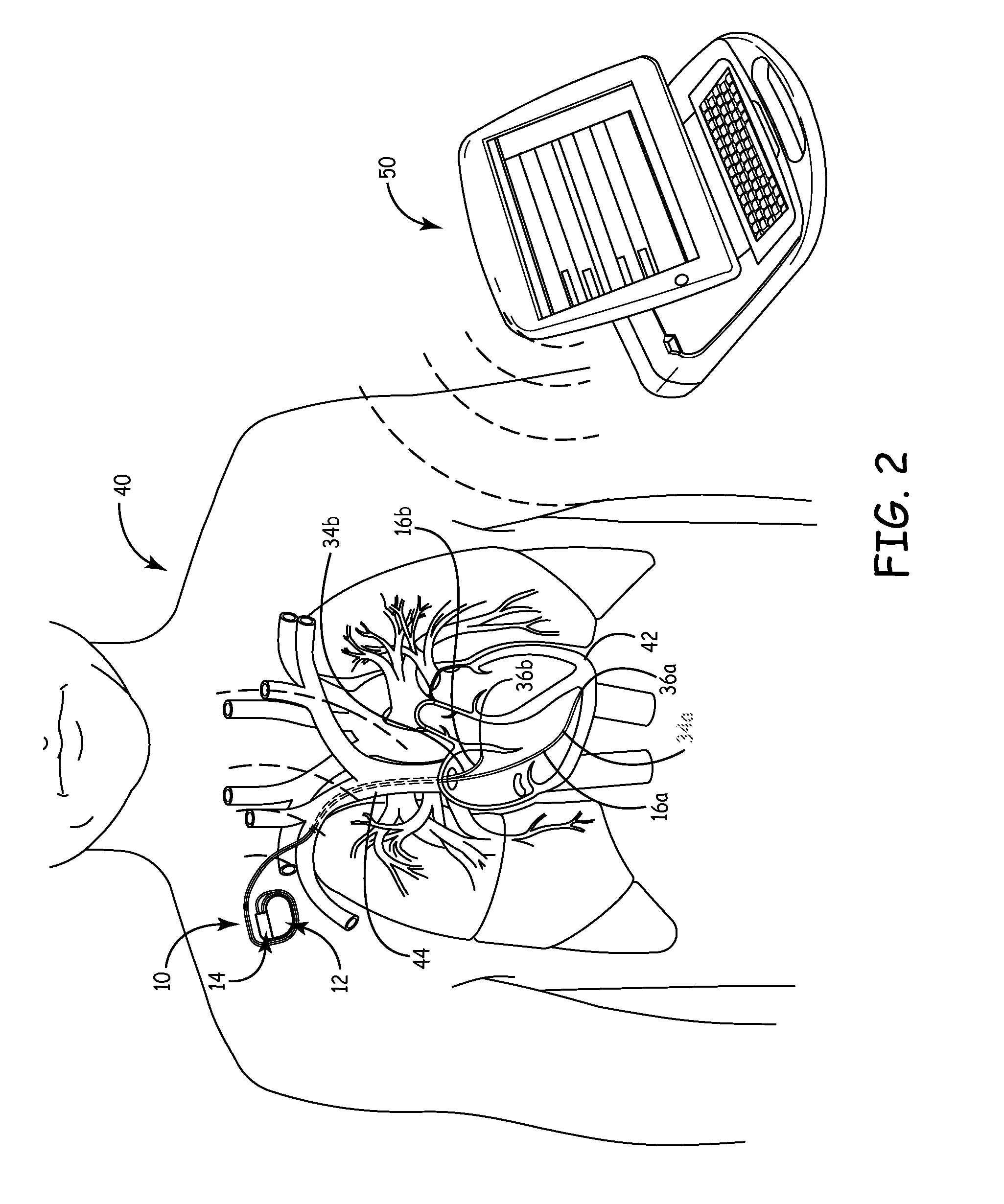 System and method for cardiac lead