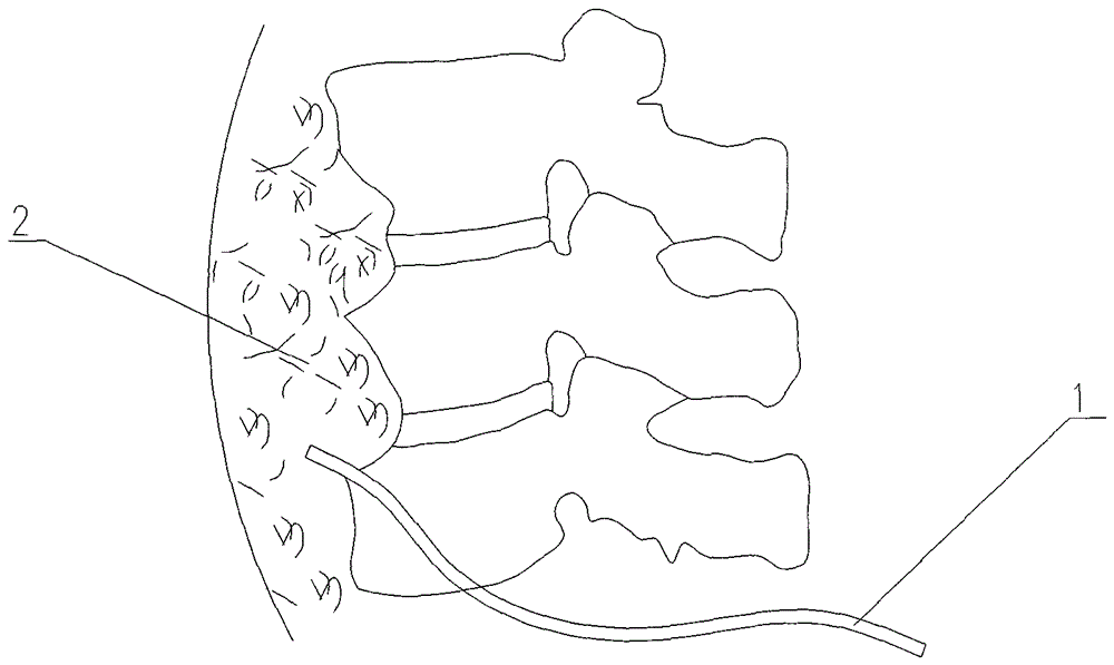 Pedicle screw and screw-rod system for the treatment of spinal tuberculosis with continuous irrigation and drainage