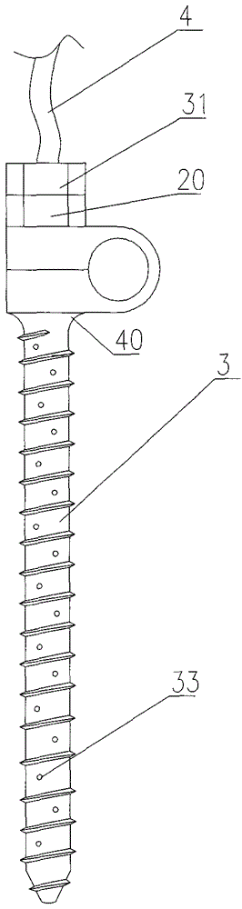 Pedicle screw and screw-rod system for the treatment of spinal tuberculosis with continuous irrigation and drainage