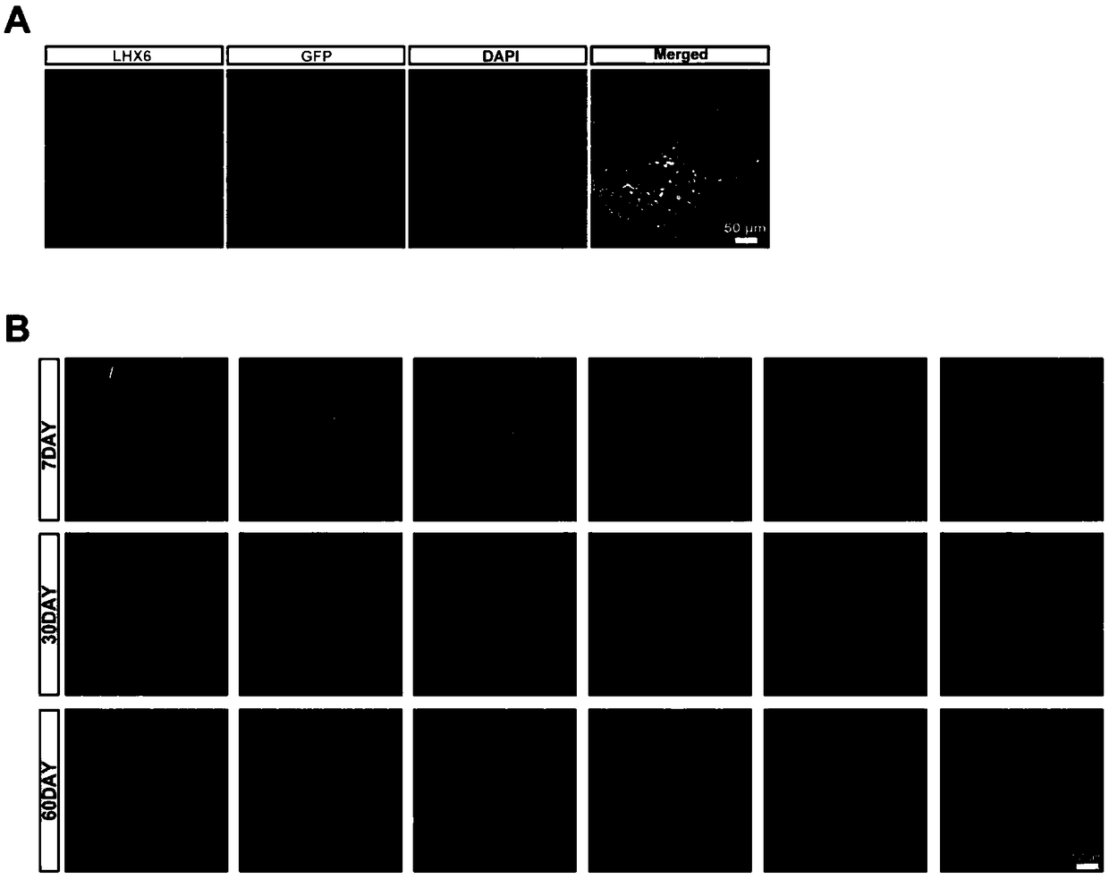 Application of inhibitory neural precursor cell to preparation of drug for treating Alzheimer's disease