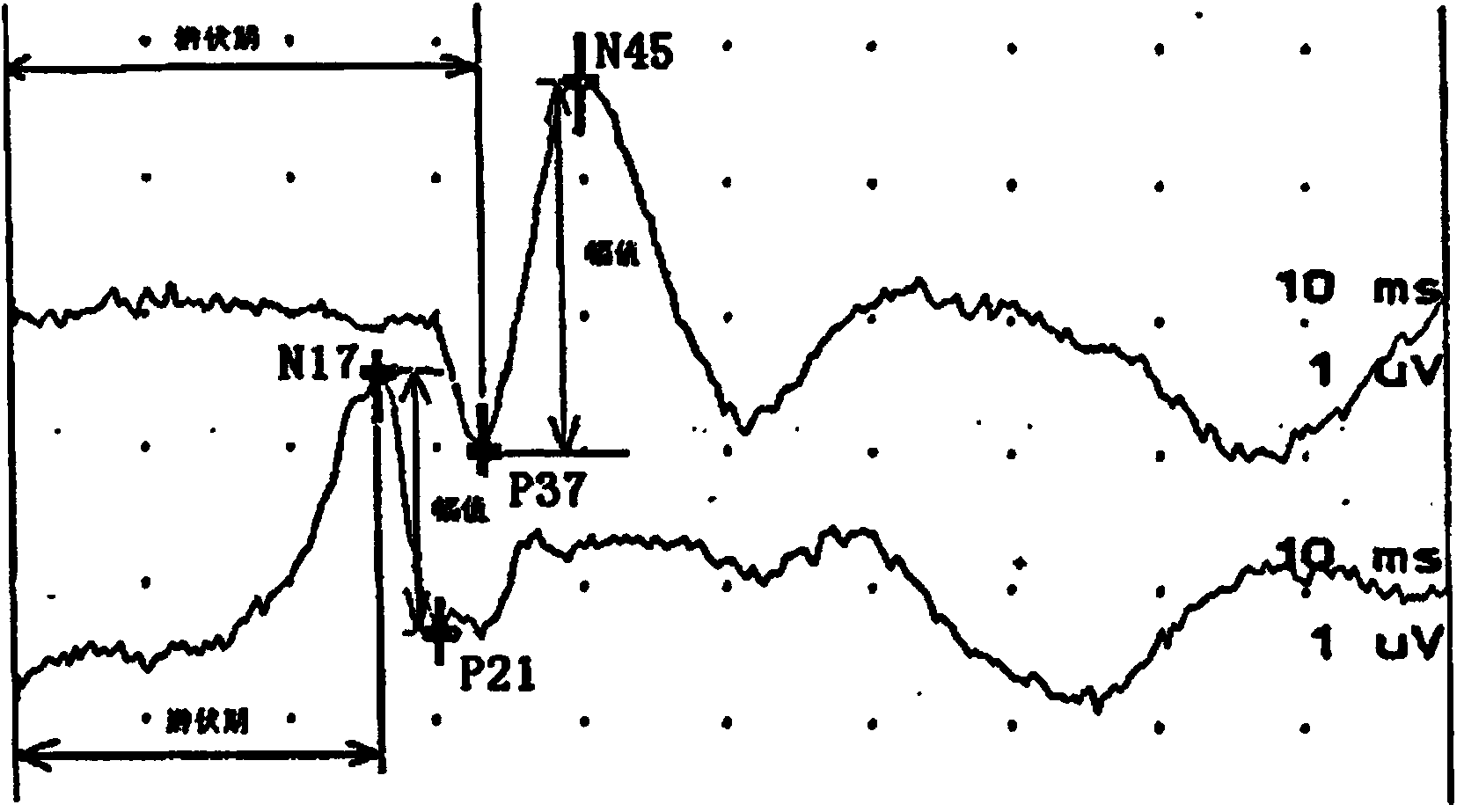 Spinal cord injury condition monitoring method based on somatosensory evoked potential signal