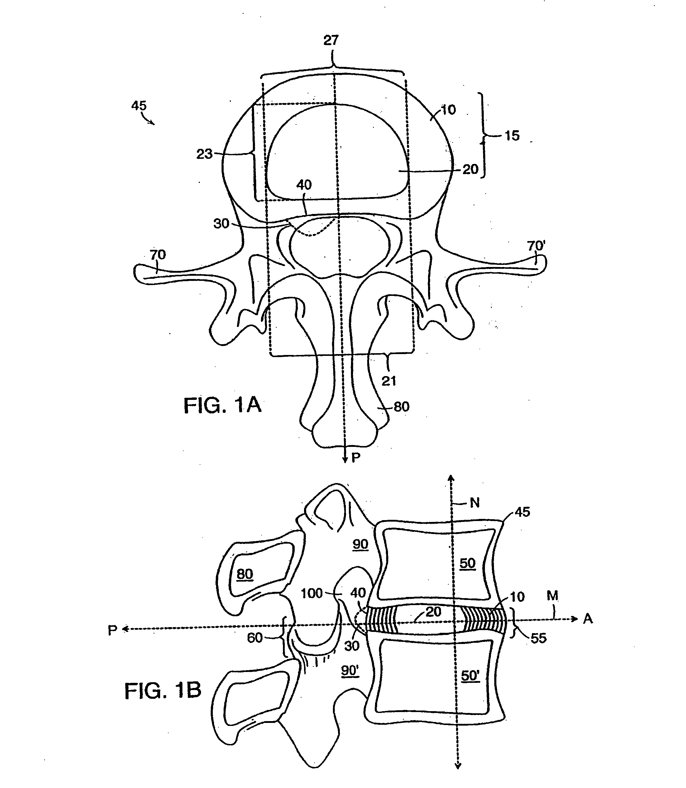 Resilient intervertebral disc implant