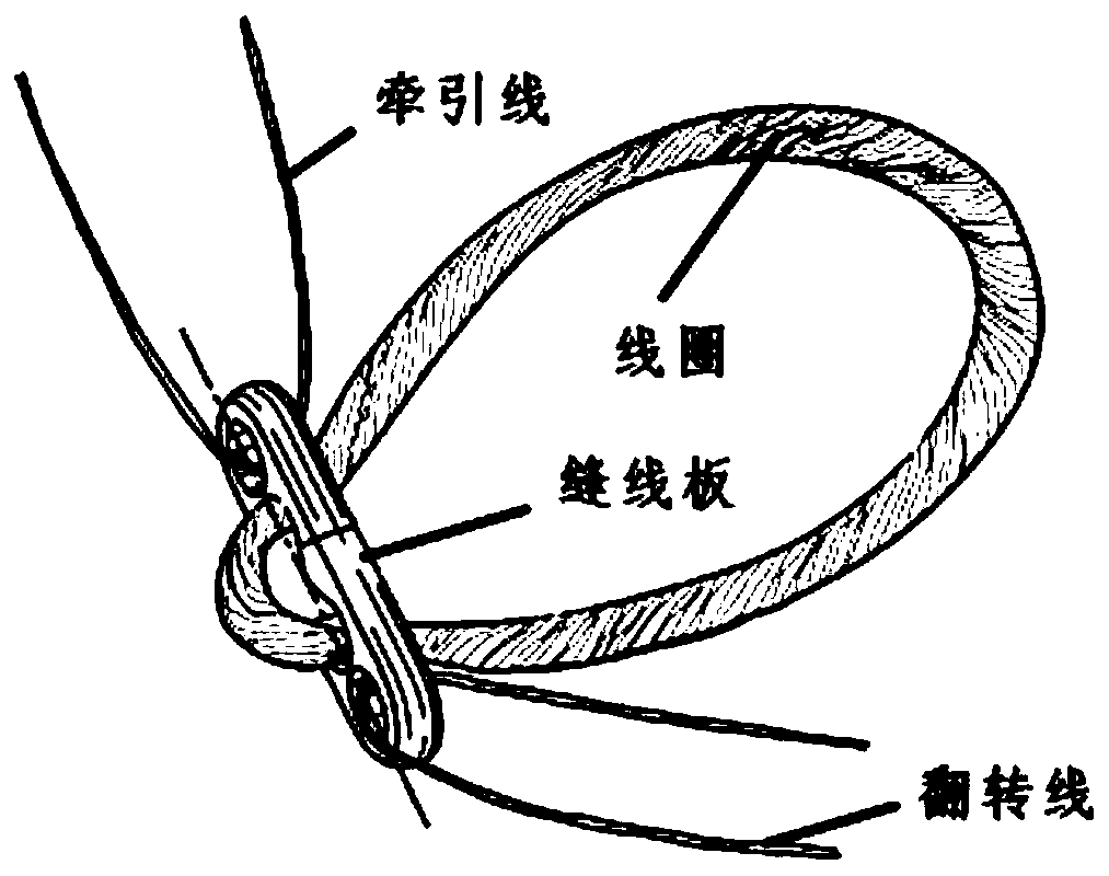 A fixation system for ligament reconstruction