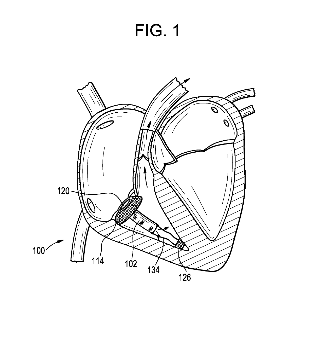 Pressure differential actuated prosthetic medical device