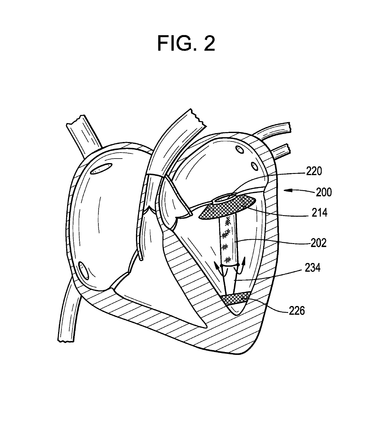 Pressure differential actuated prosthetic medical device