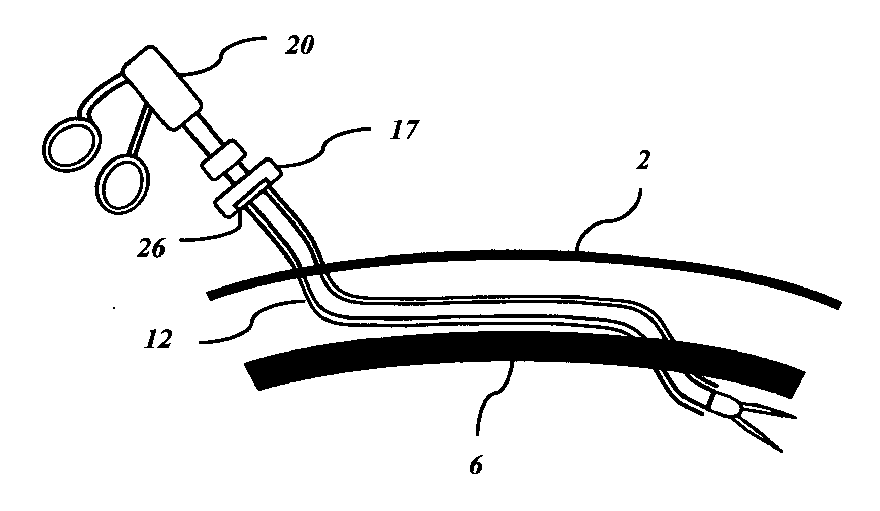 Transverse surgical tunneling