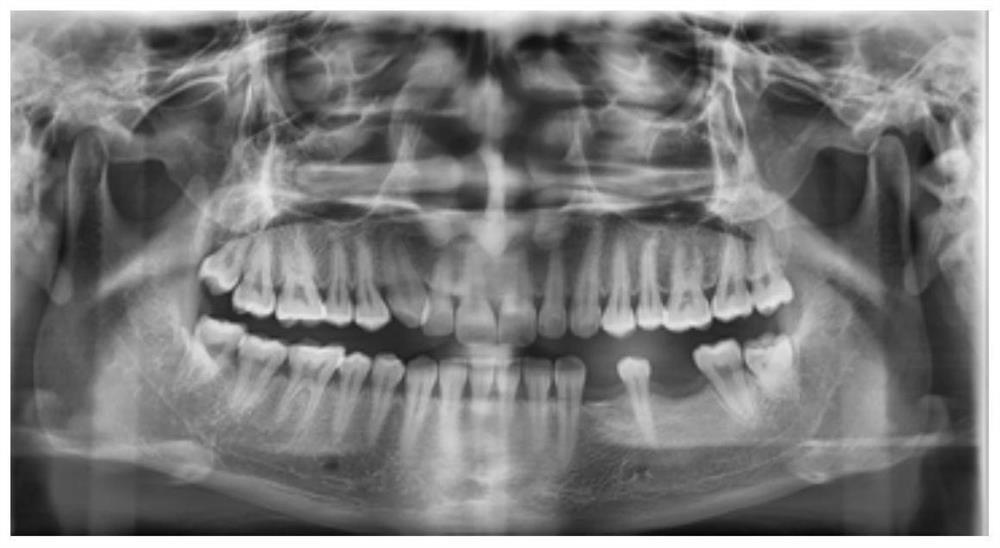 Device for assisting in invisibly correcting to carry out mesial movement of molar and correcting method