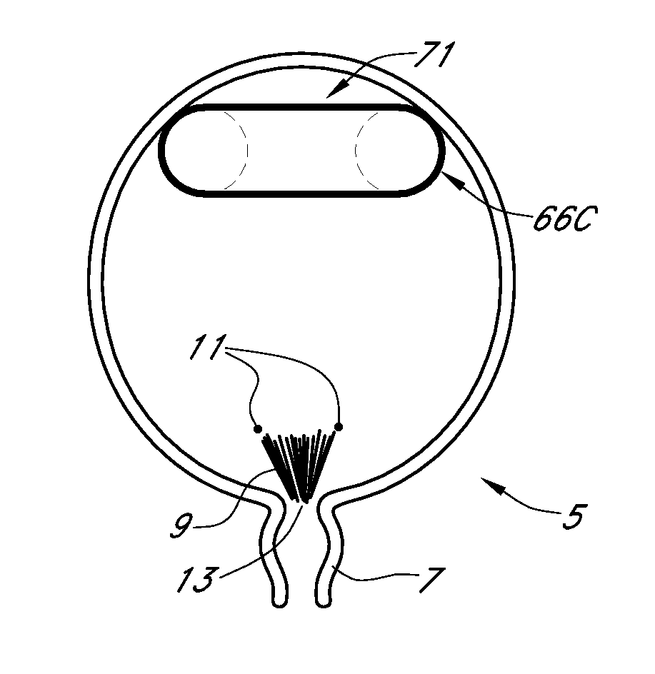 Implant with high vapor pressure medium