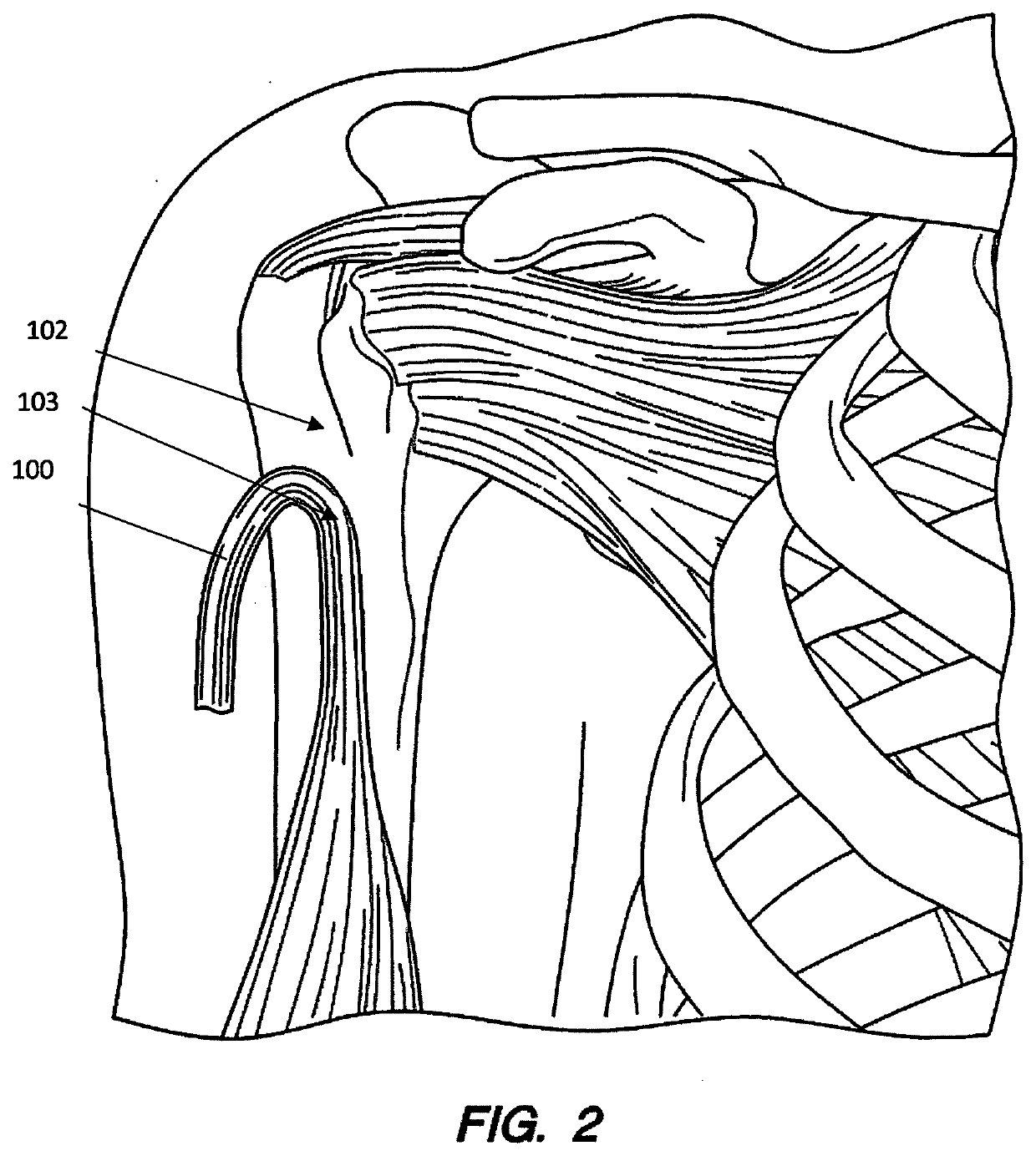 Direct soft tissue fixation implantable device and method of use