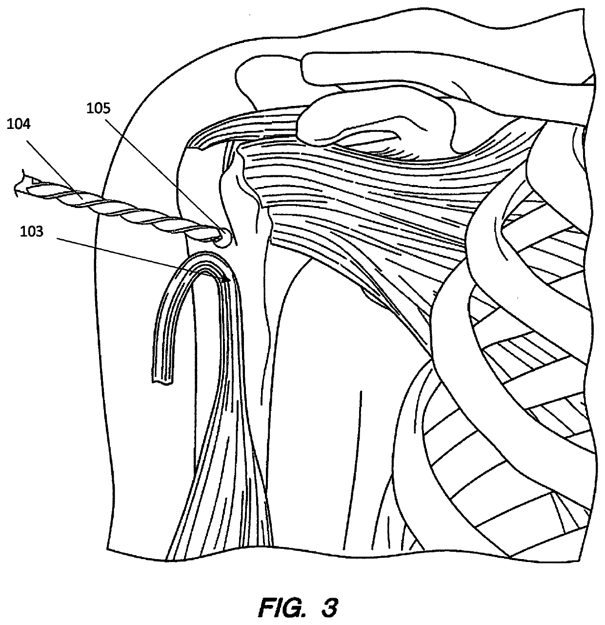 Direct soft tissue fixation implantable device and method of use