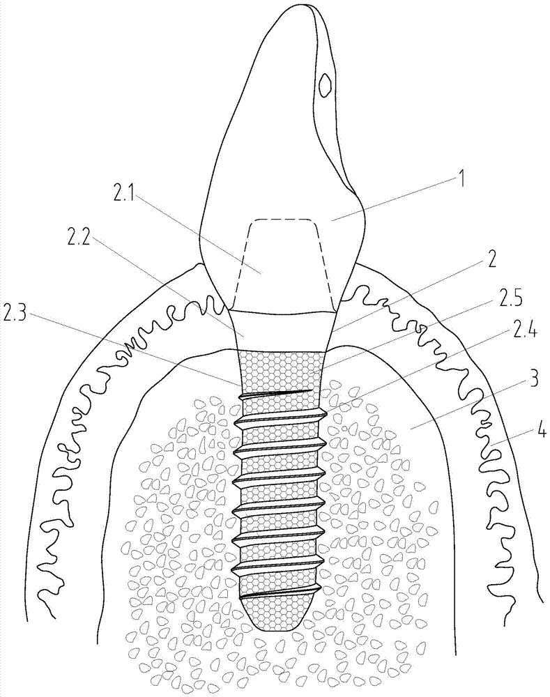 Production method of bone tissue engineering scaffold material artificial tooth root capable of improving synostosis