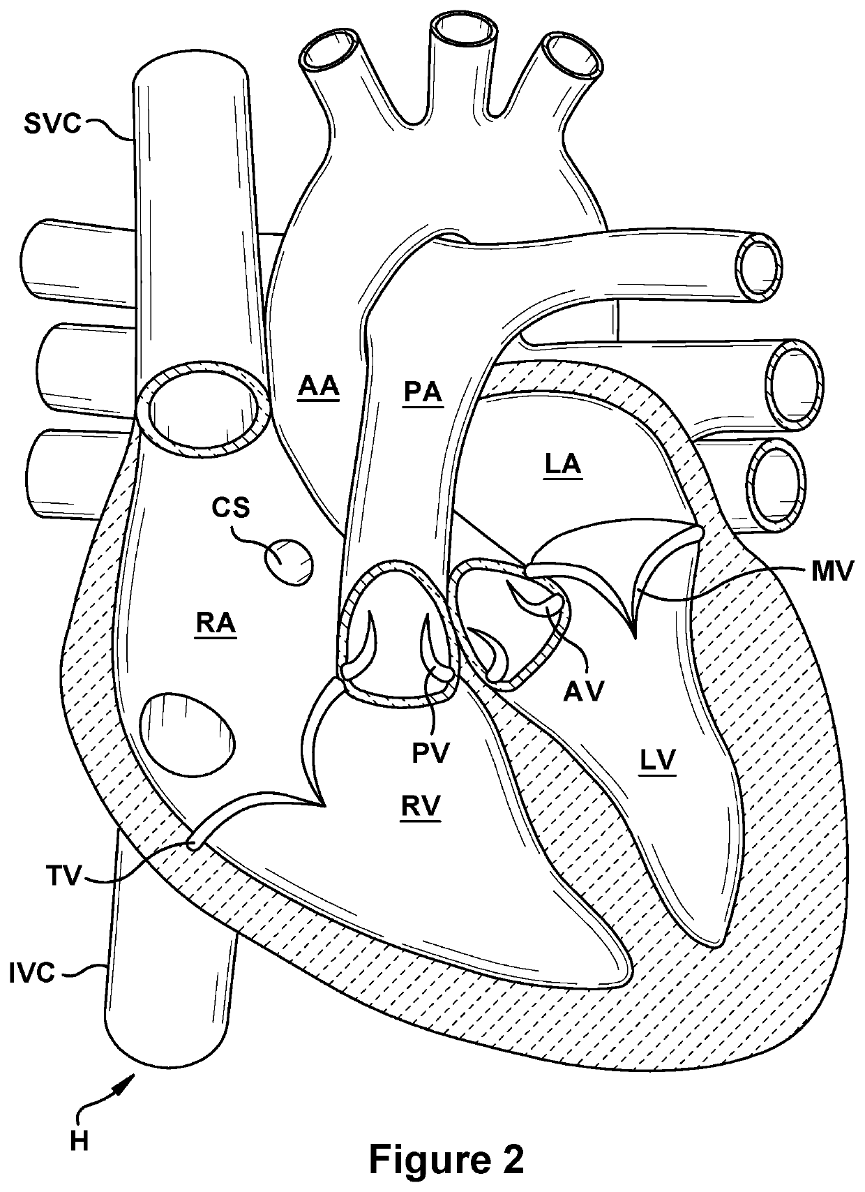 Native valve repair devices and procedures