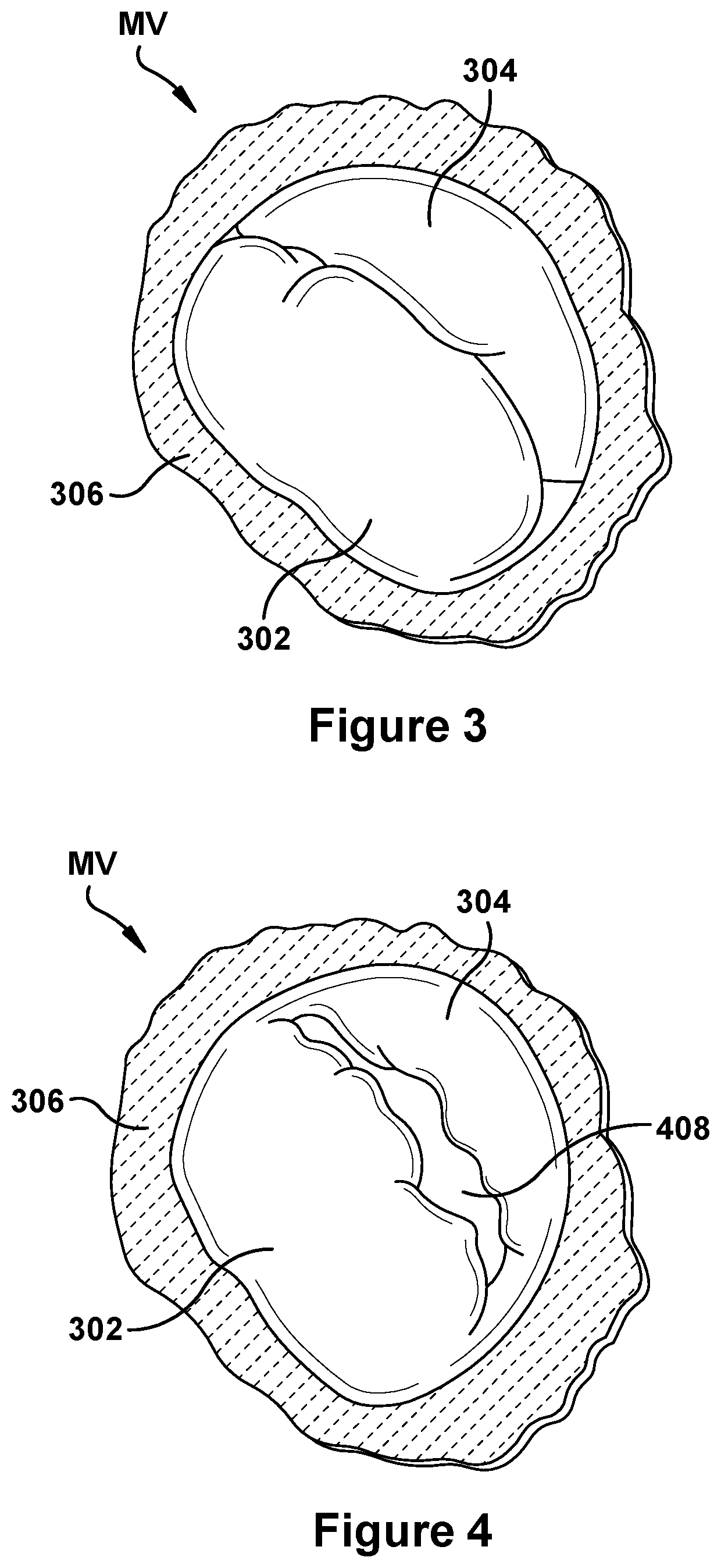 Native valve repair devices and procedures