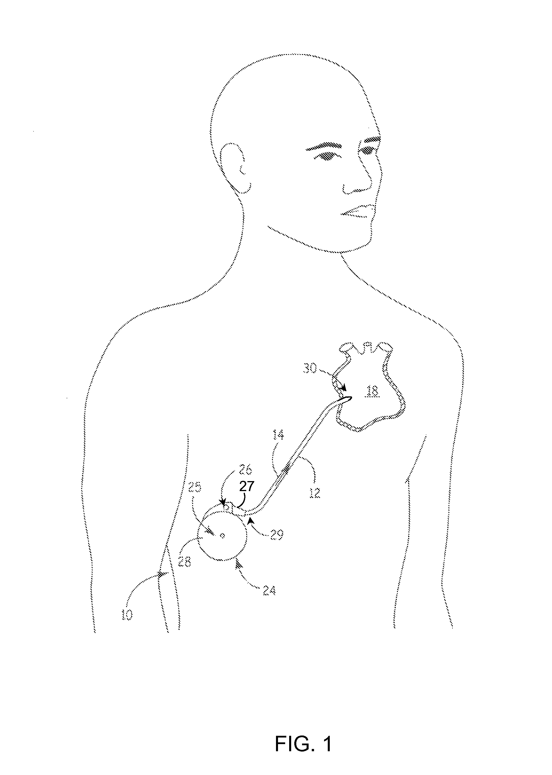 Pressure monitoring to control delivery of therapeutic agent