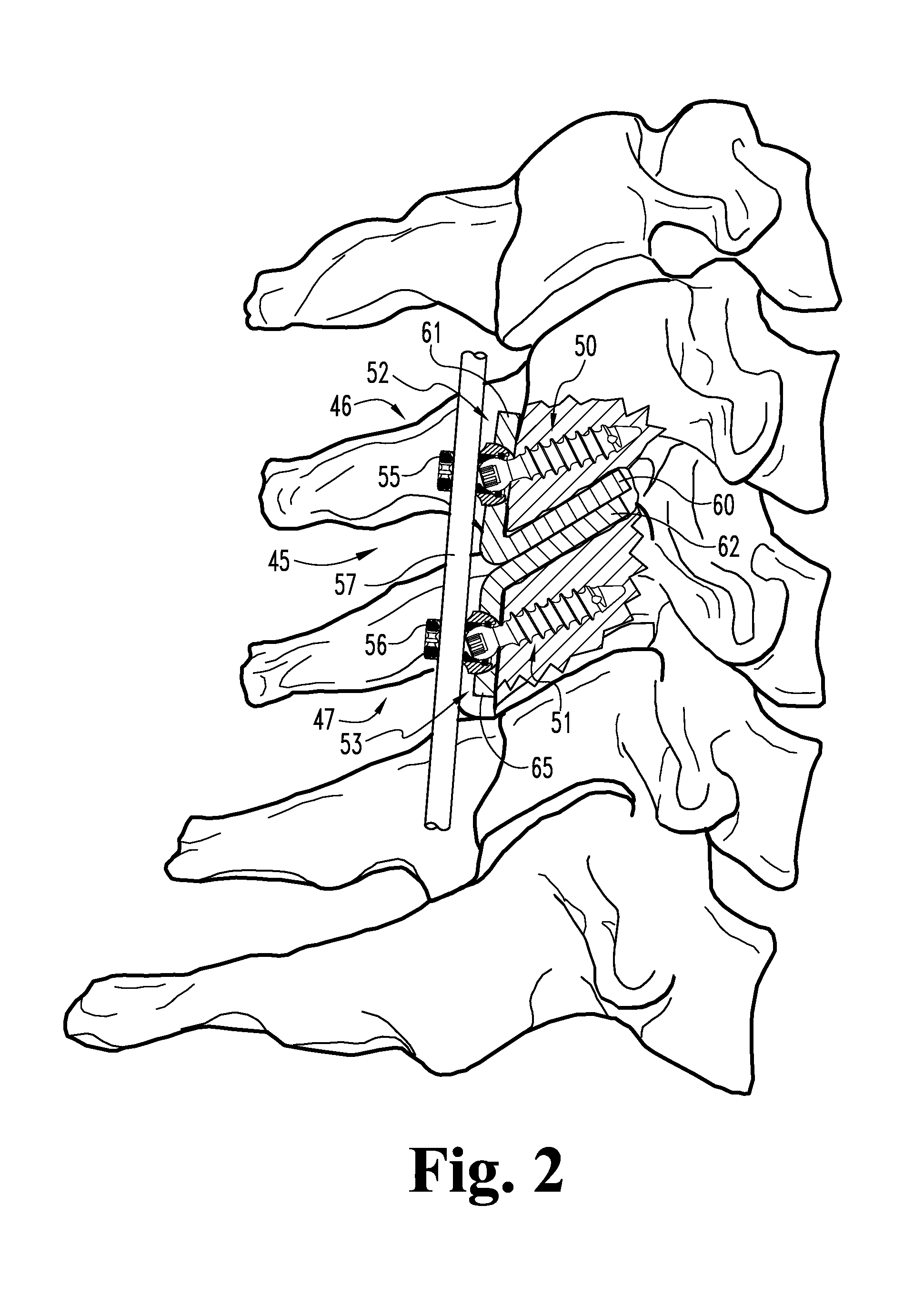 Replacement facet joint and method