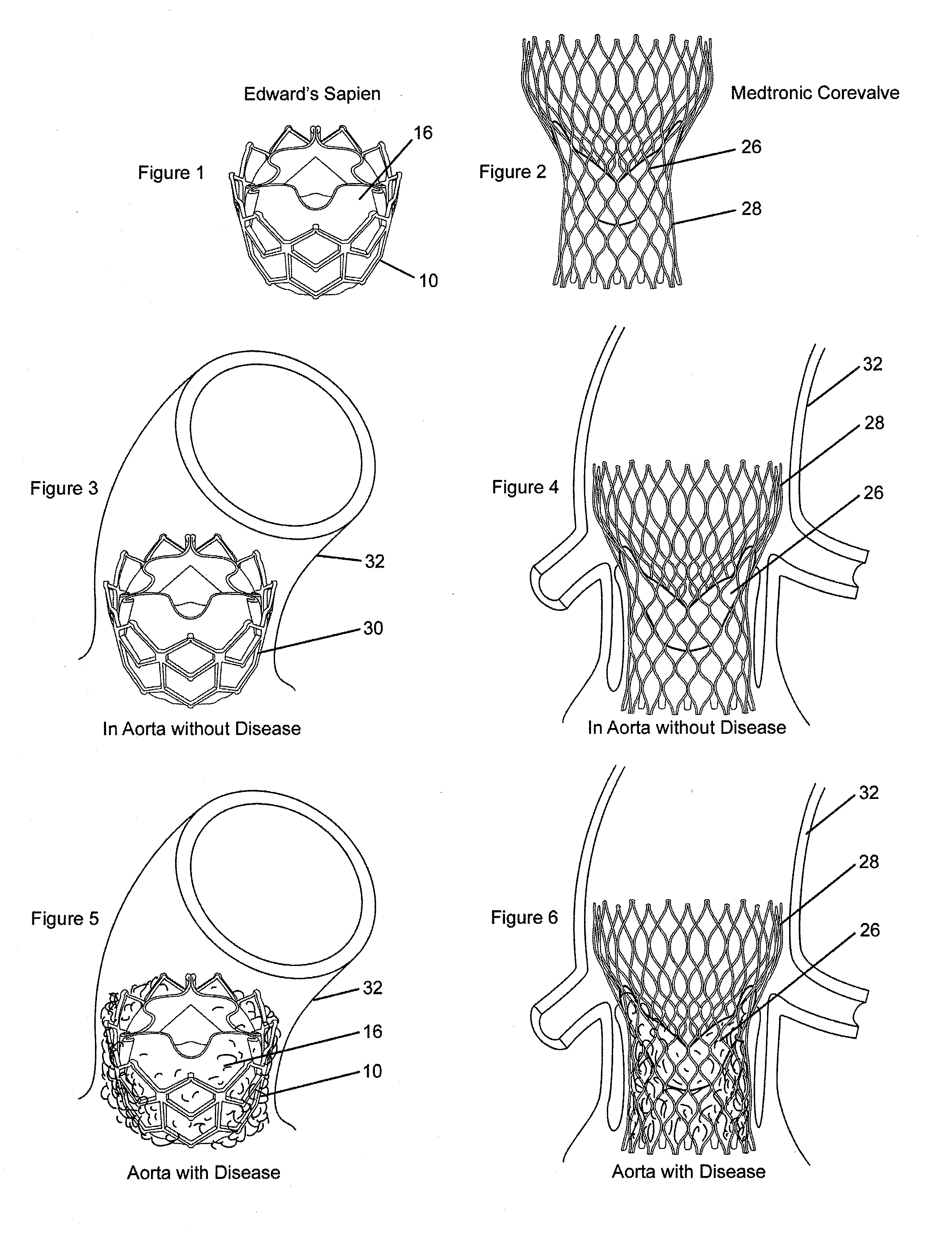 Methods for inhibiting stenosis, obstruction, or calcification of a stented heart valve