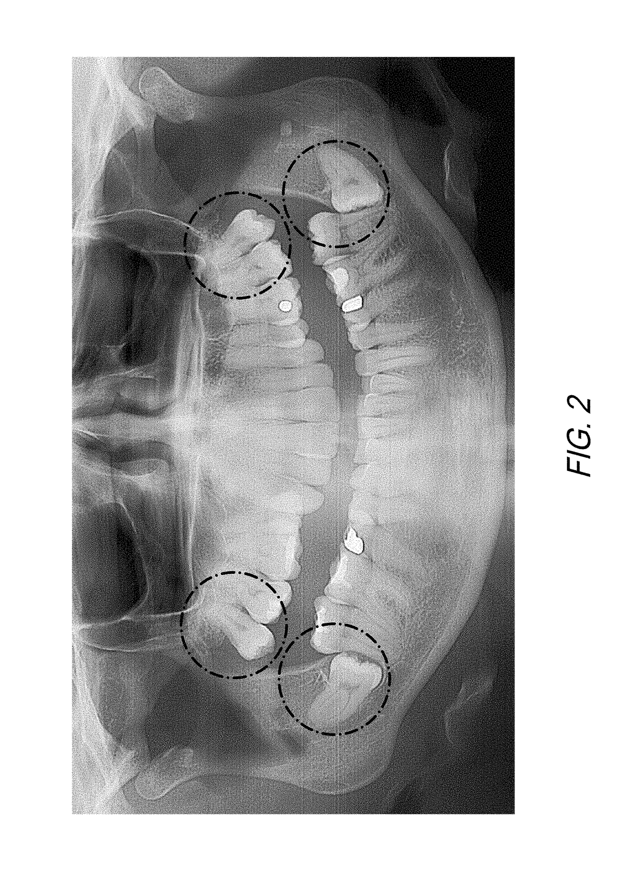 Therapeutic tooth bud ablation