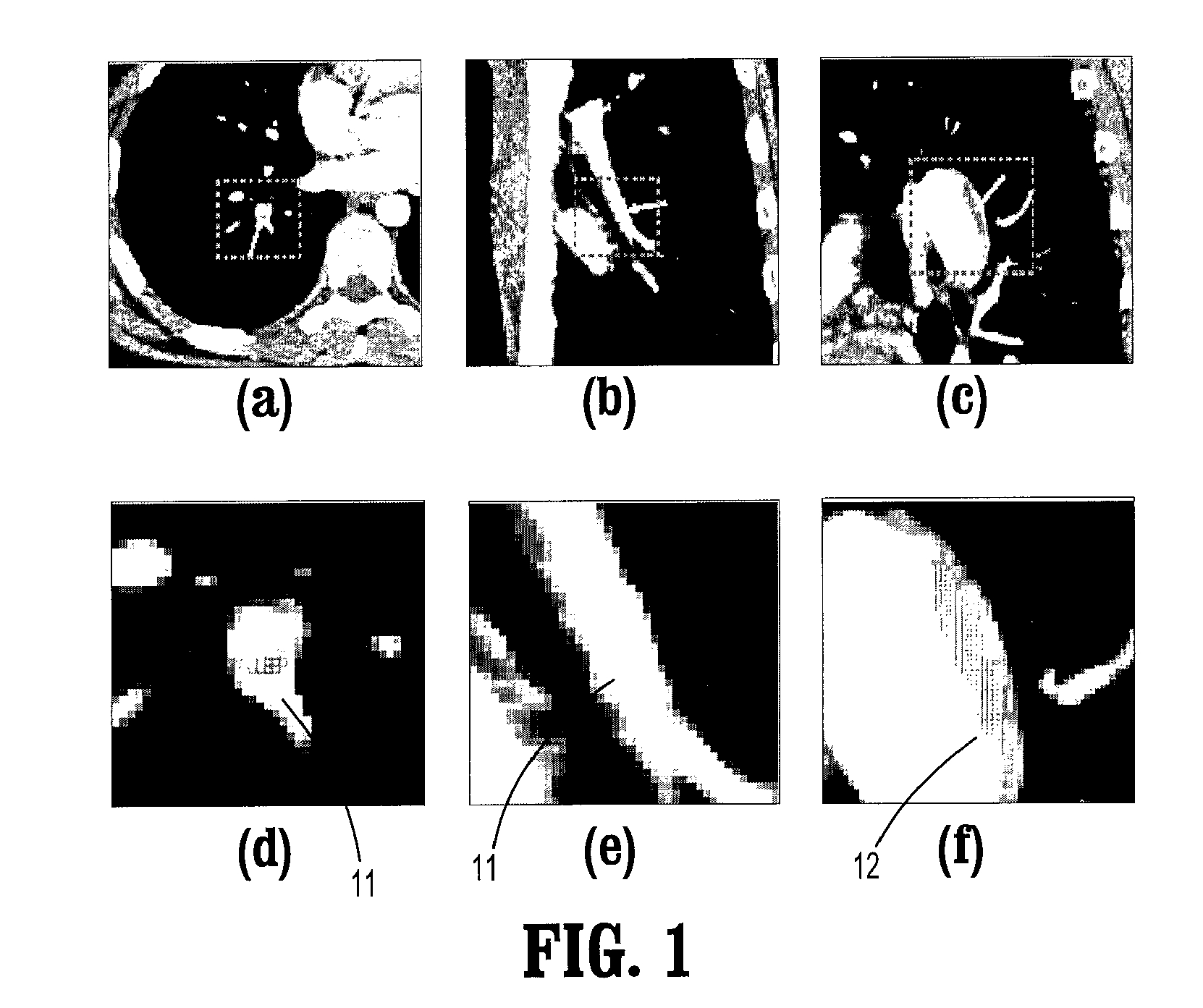 System and method for computer aided detection of pulmonary embolism in tobogganing in CT angiography