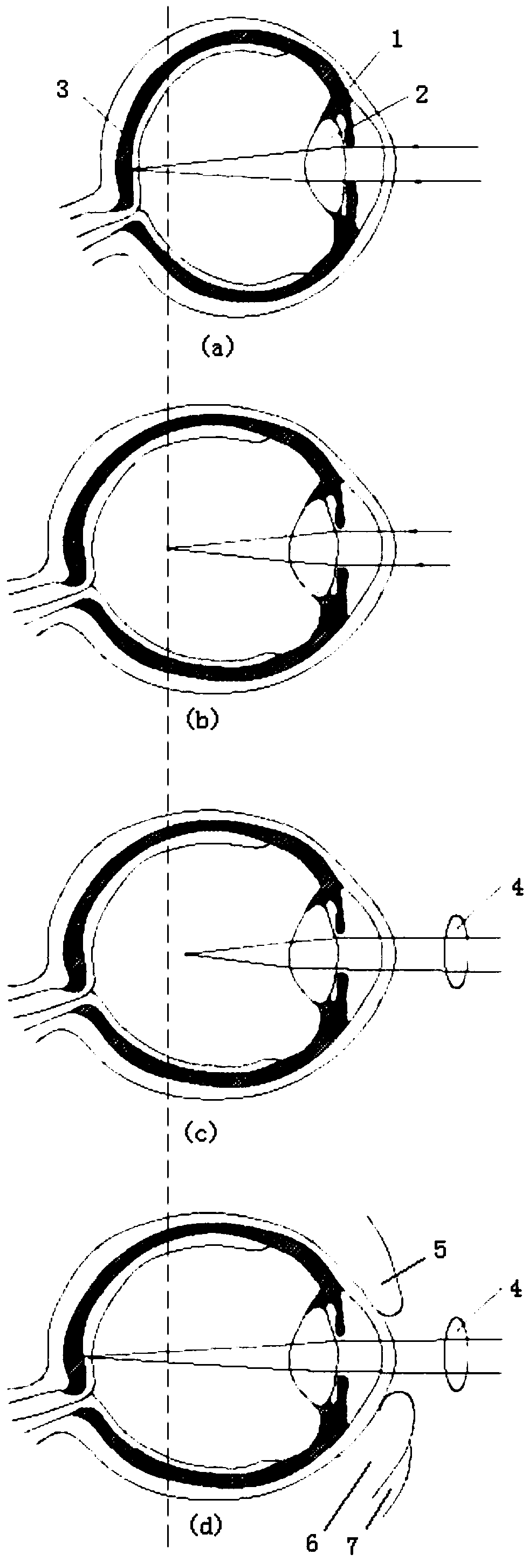 Ciliary muscle intraocular pressure focus correction method and device