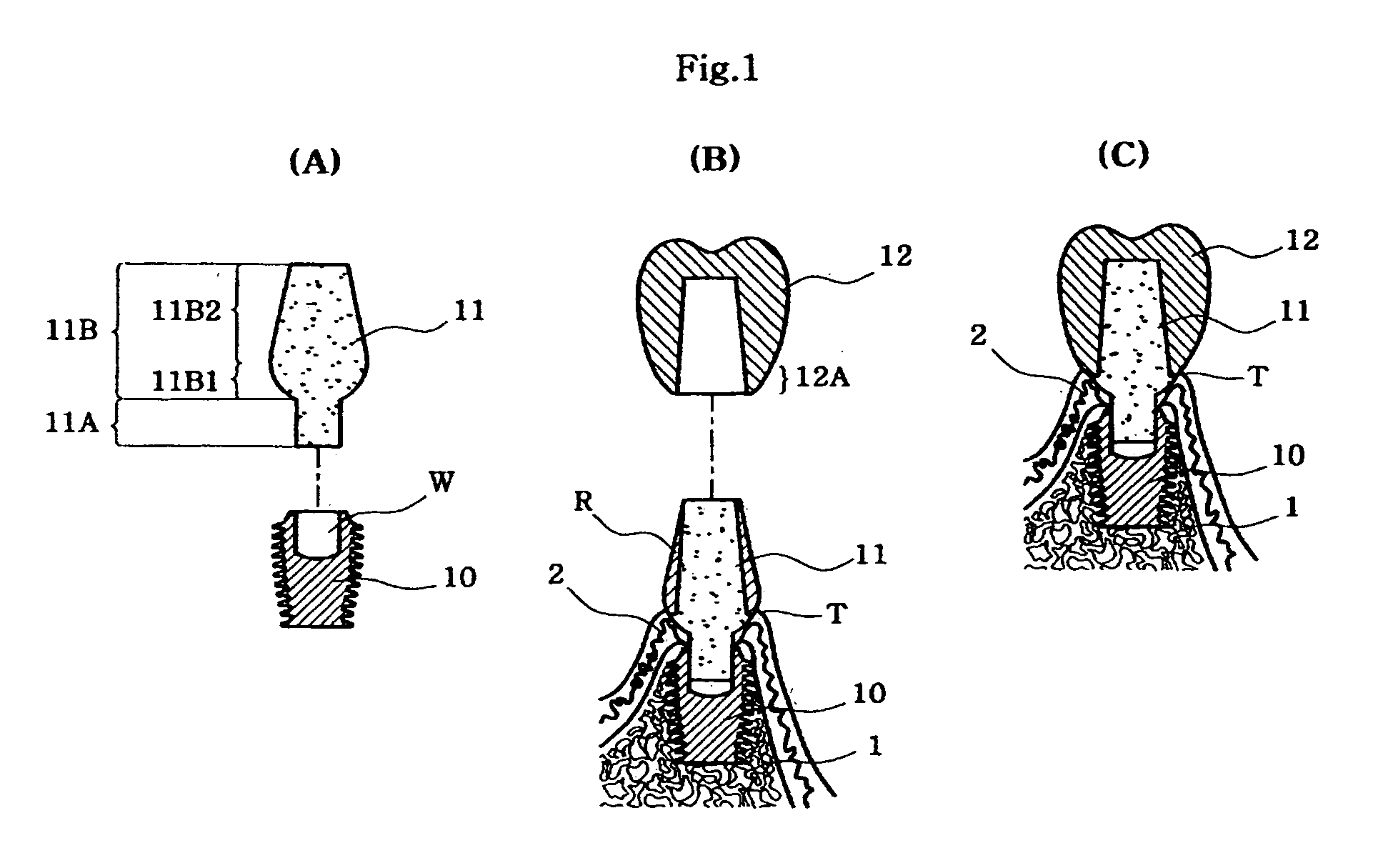 Locking-taper abutment for dental implants