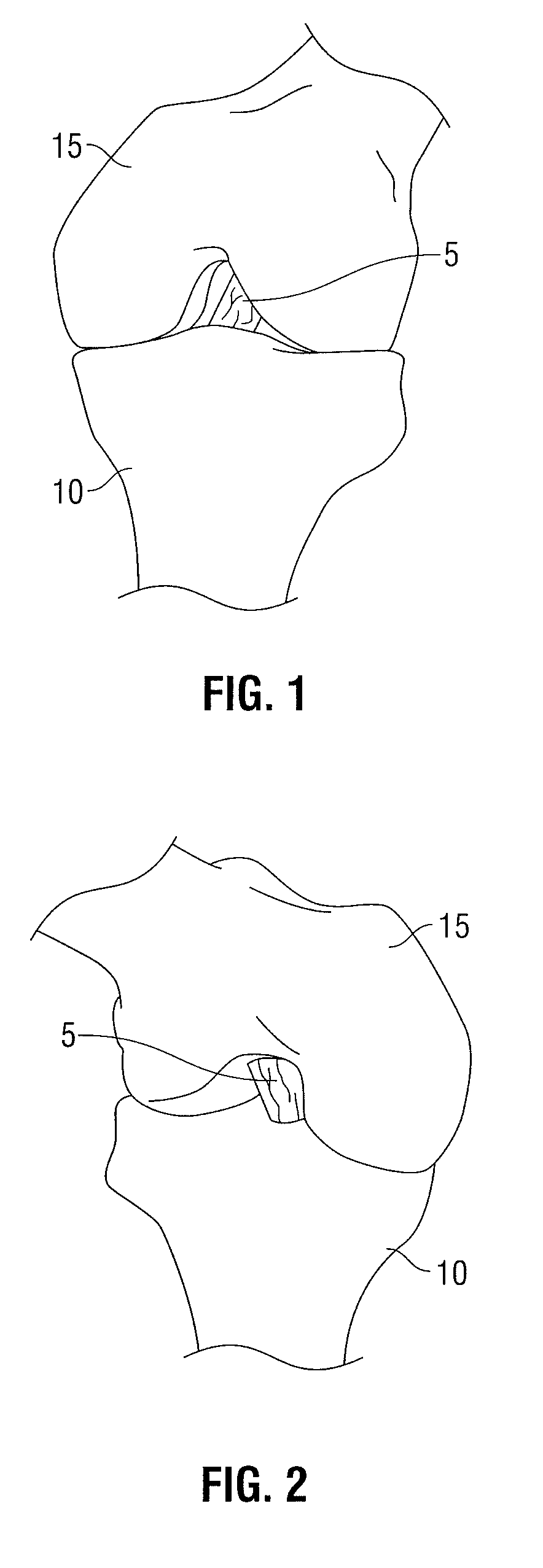 Device for orienting the tibial tunnel position during an acl reconstruction