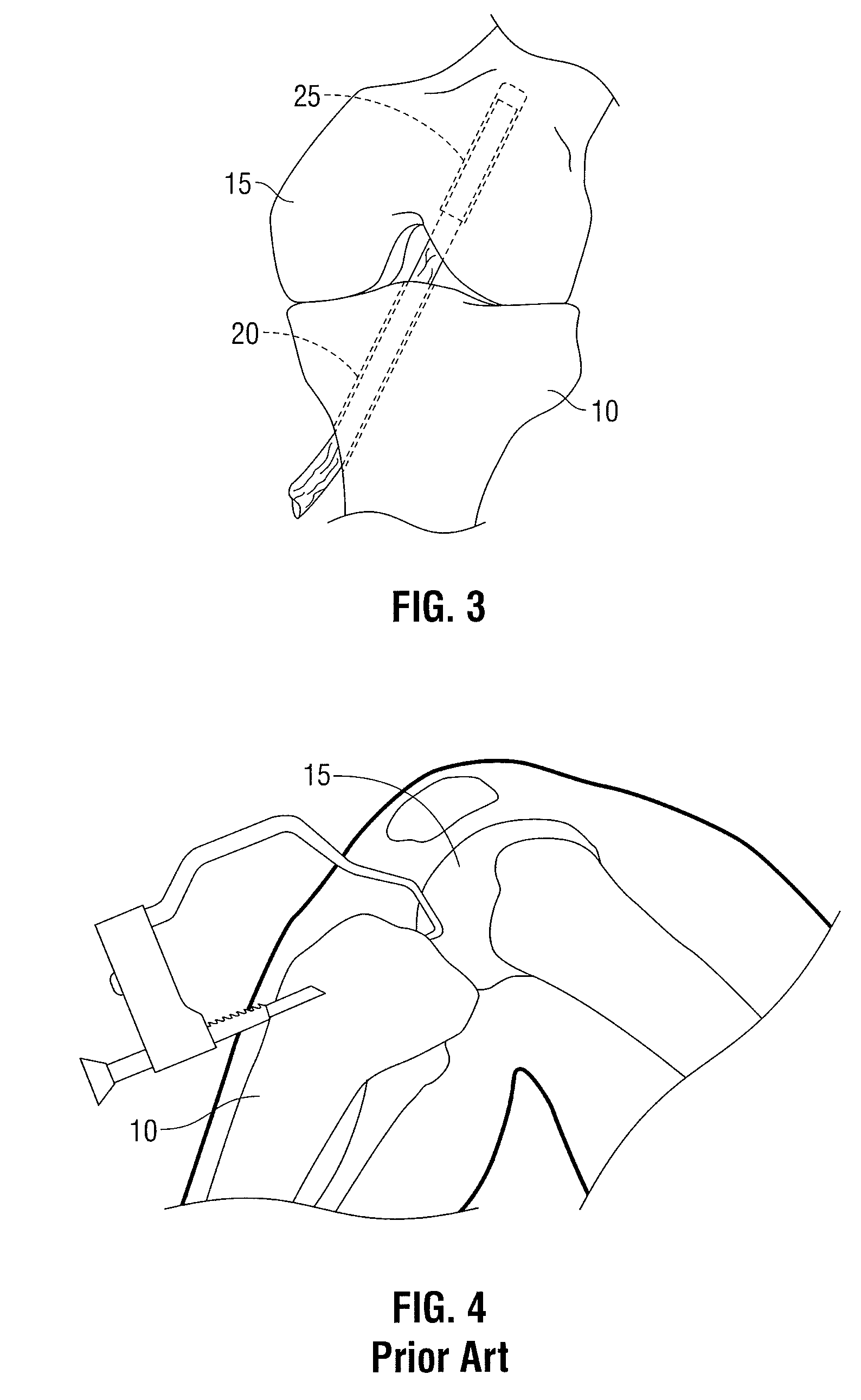 Device for orienting the tibial tunnel position during an acl reconstruction