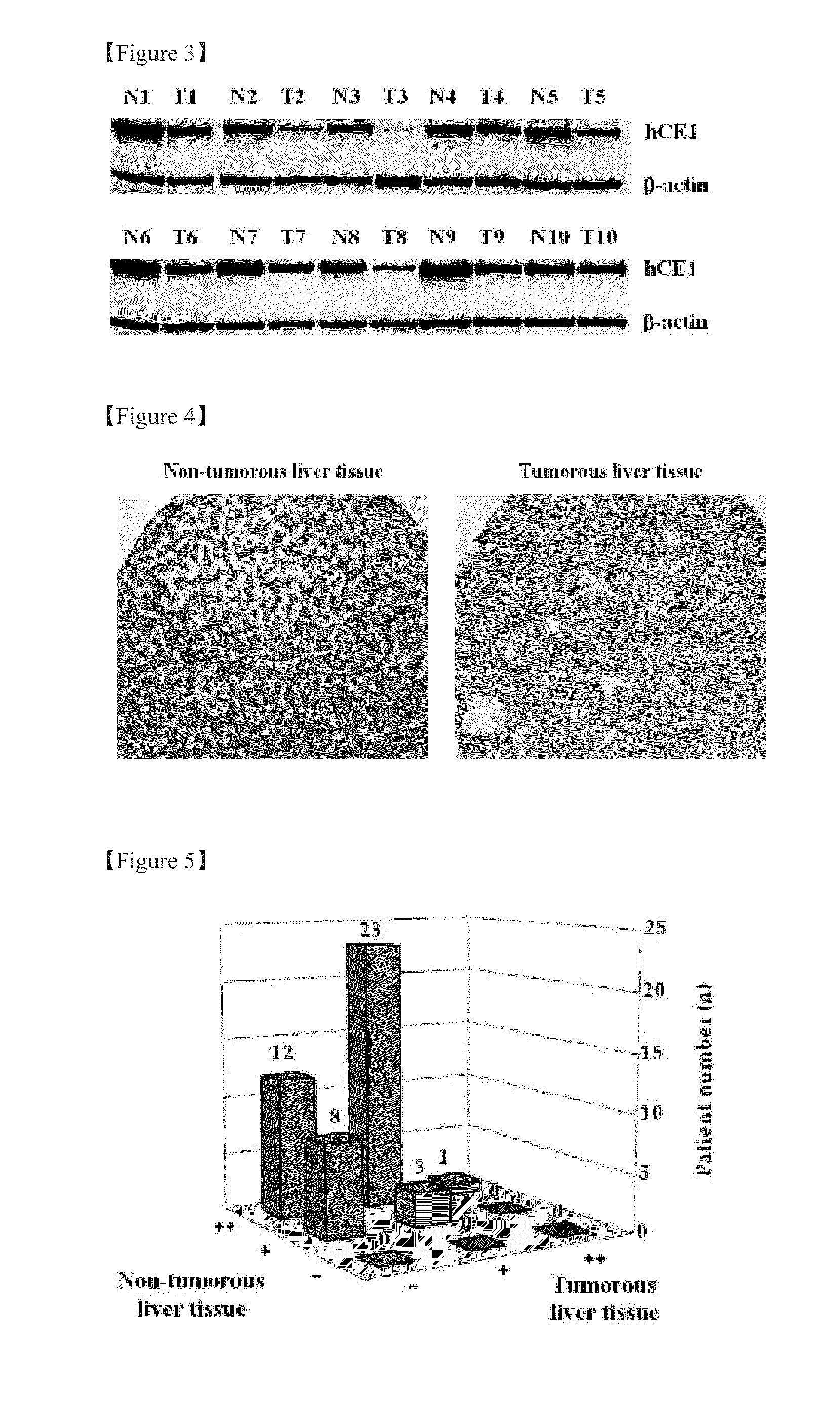 Plasma biomarker tool for the diagnosis of liver cancer comprising liver carboxylesterase 1 and liver cancer screening method