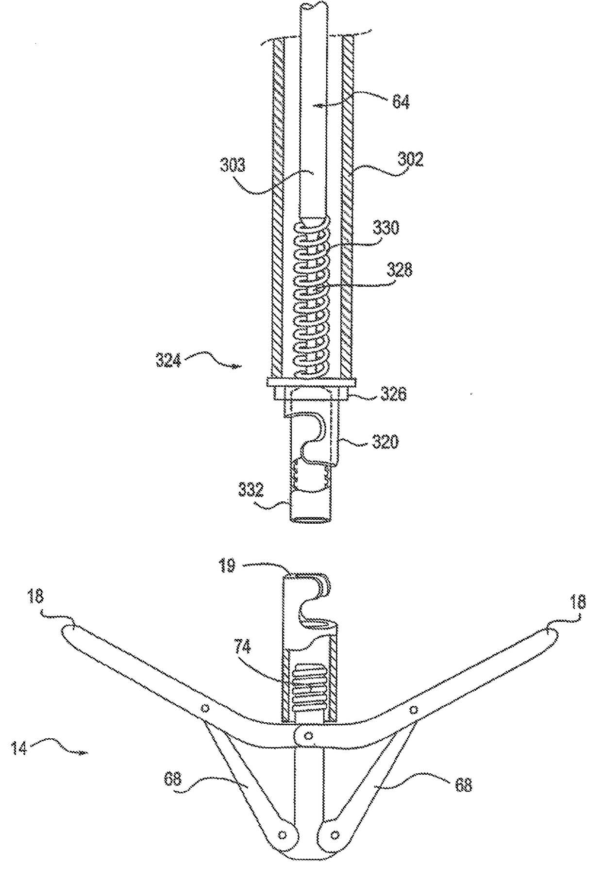 Mitral valve fixation device removal devices and methods