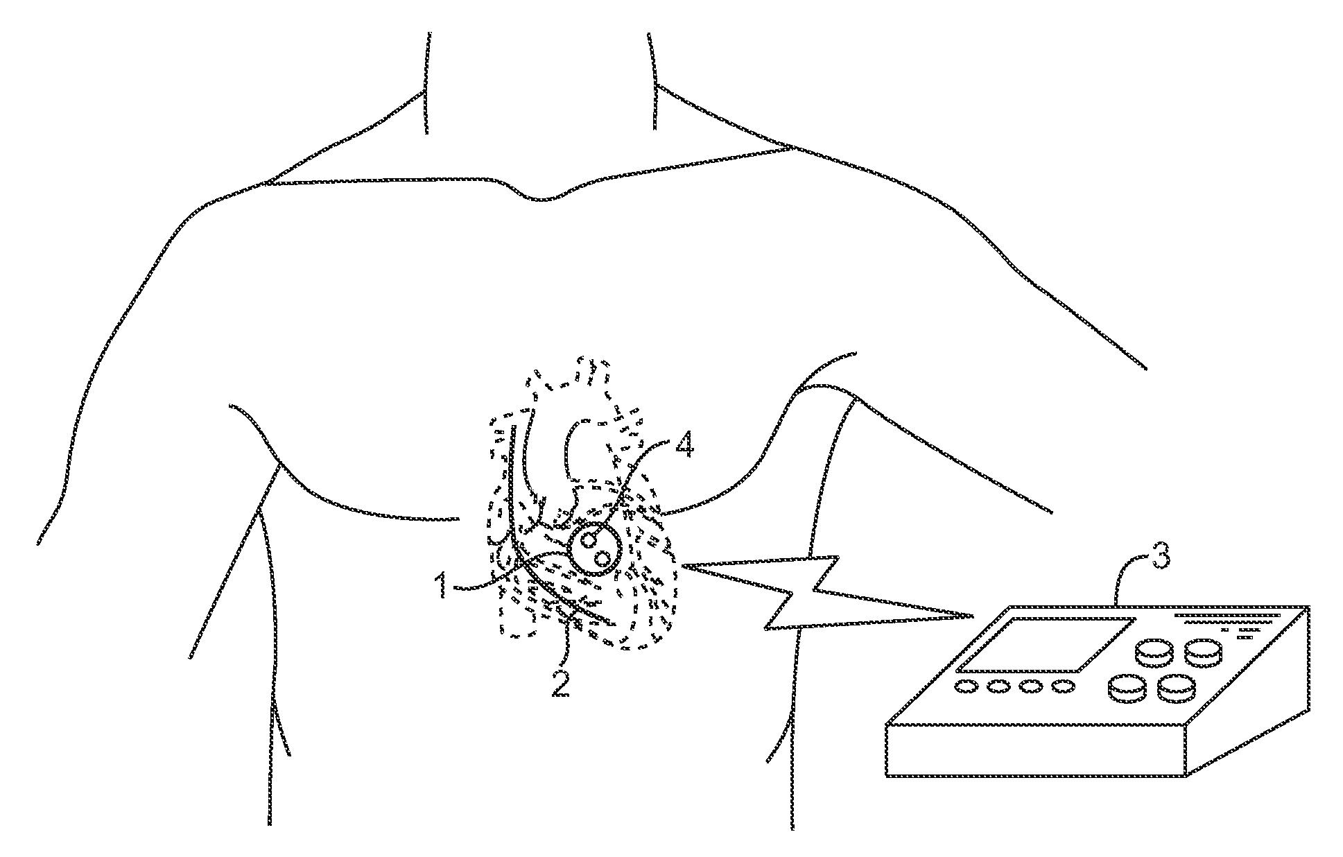 Acoustically-powered wireless defibrillator