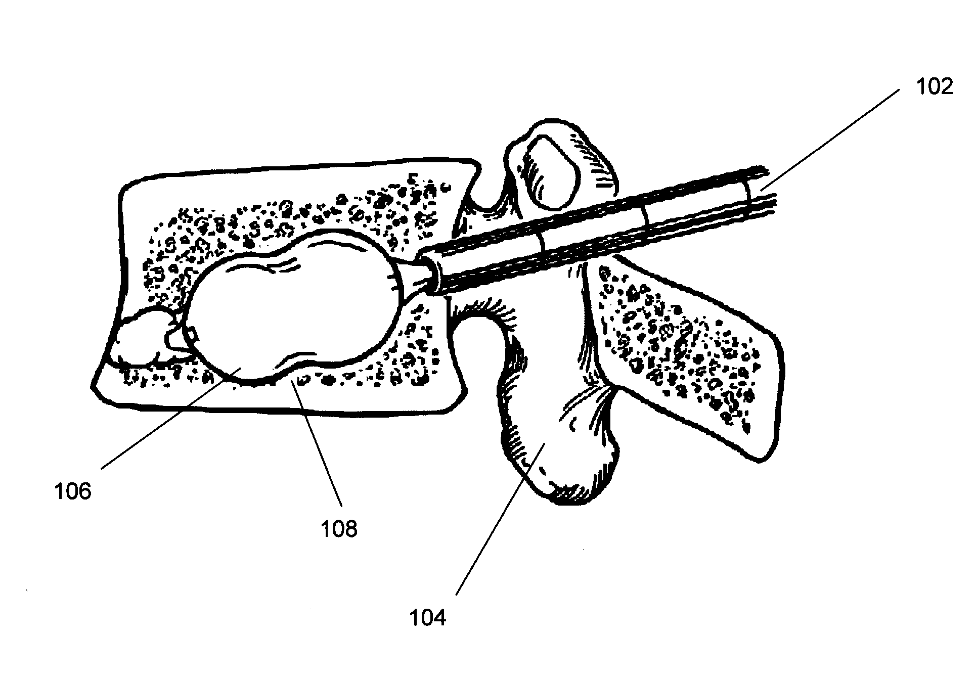 Biologic balloon and method of use