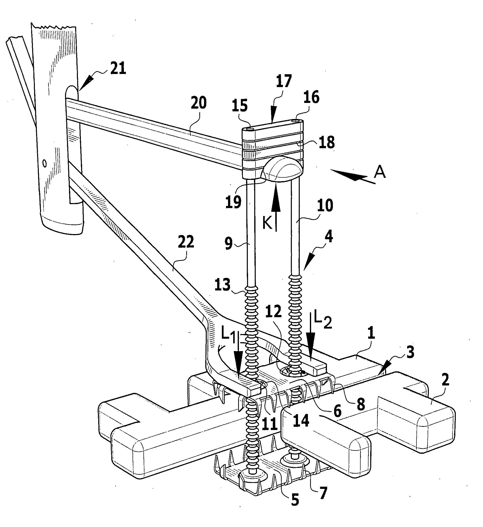 Implant for fixing two bone parts to be connected to each other