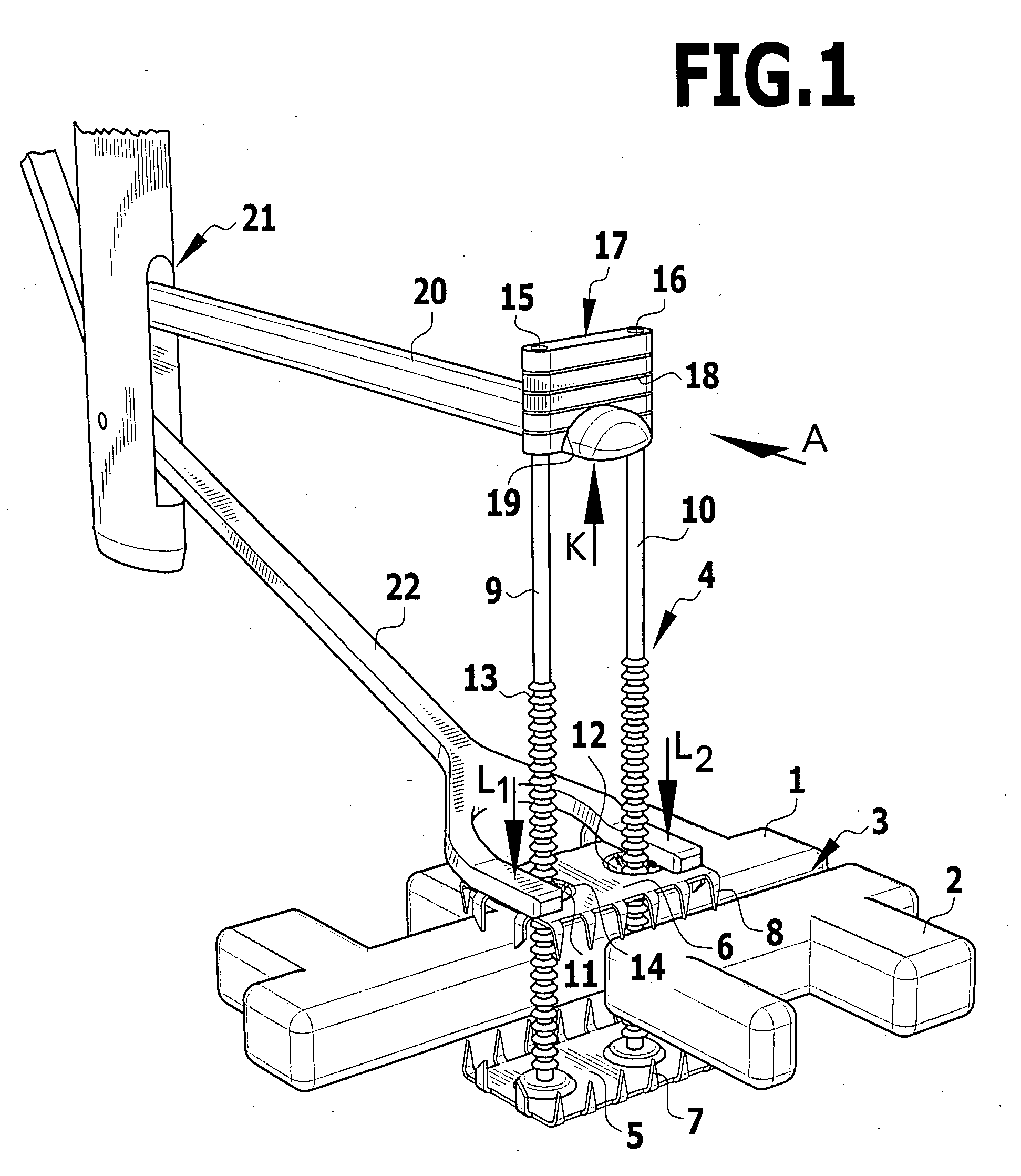 Implant for fixing two bone parts to be connected to each other