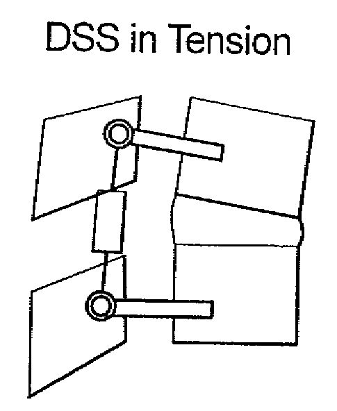 Method for stabilizing a spinal segment