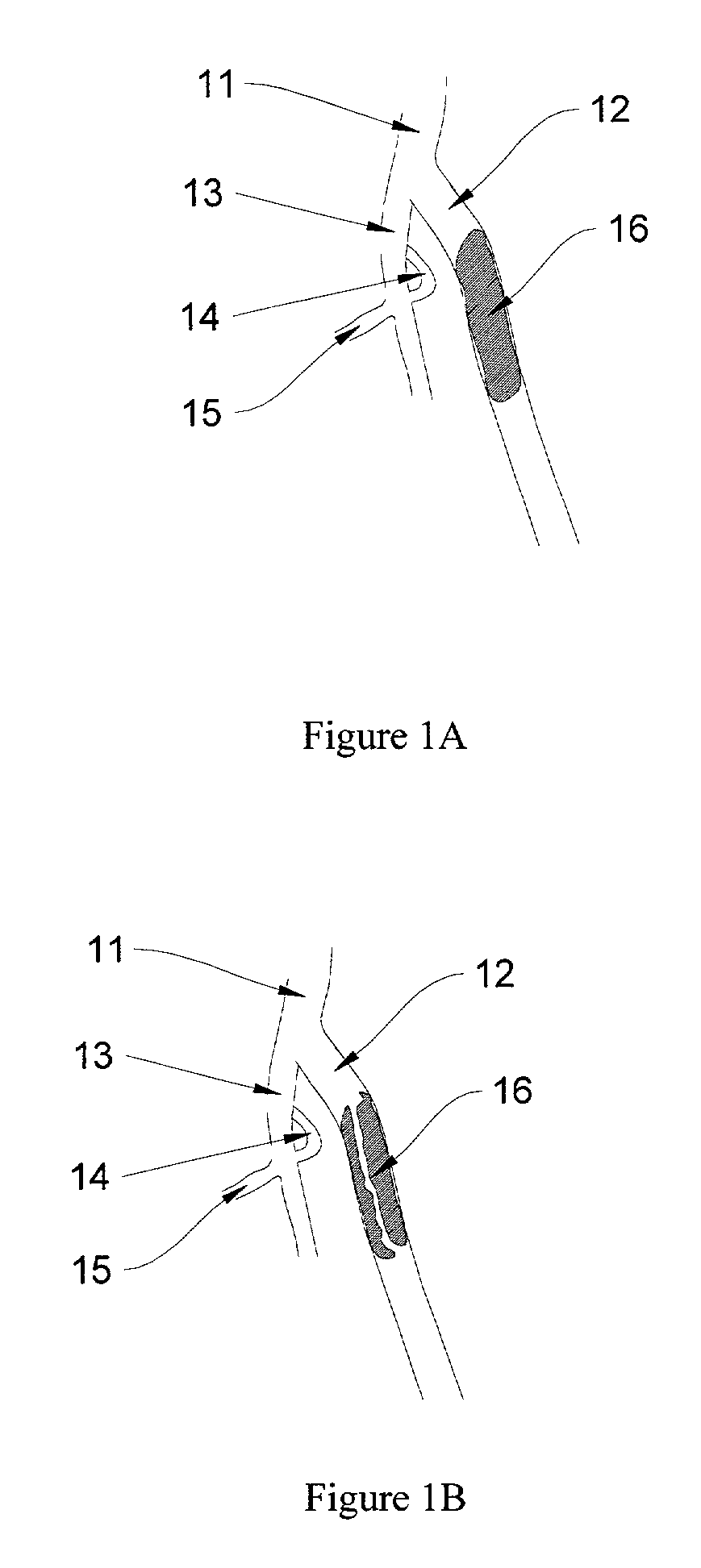 Methods for enhancing fluid flow through an obstructed vascular site, and systems and kits for use in practicing the same