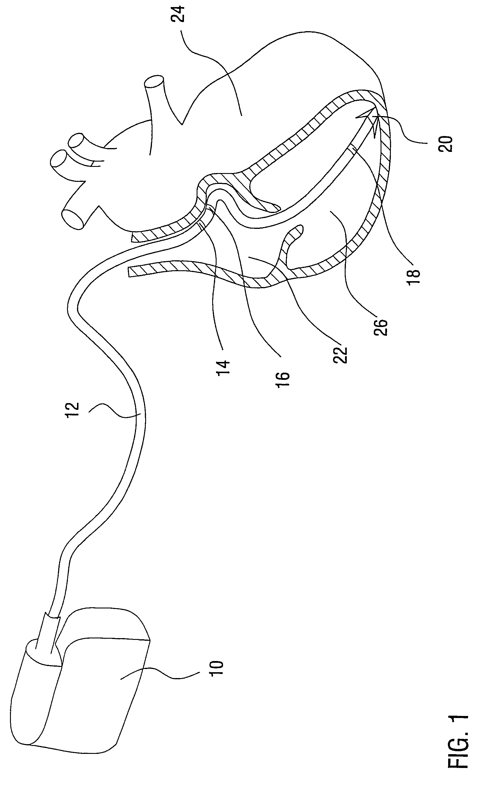 Cardiac pacemaker