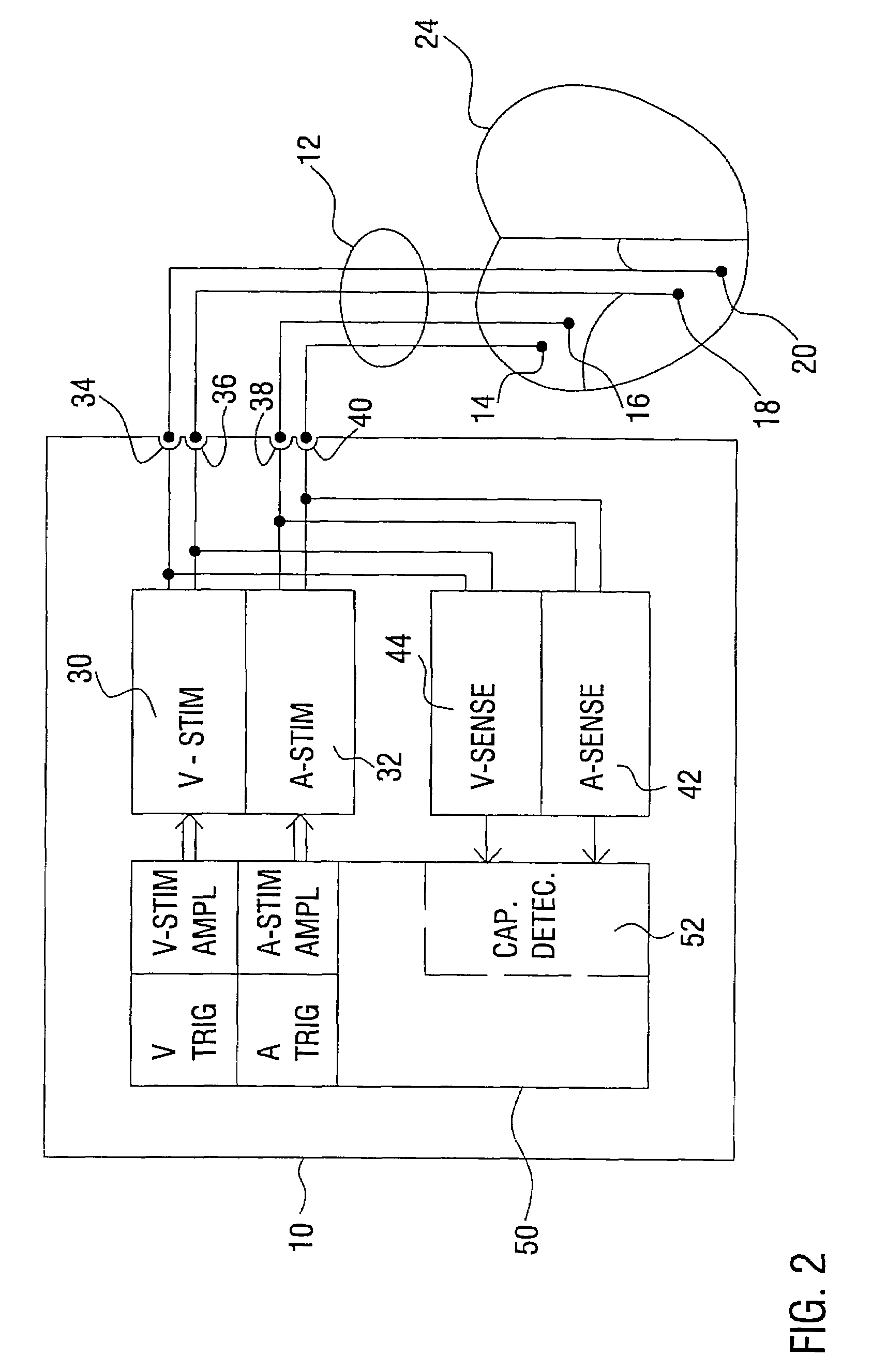 Cardiac pacemaker