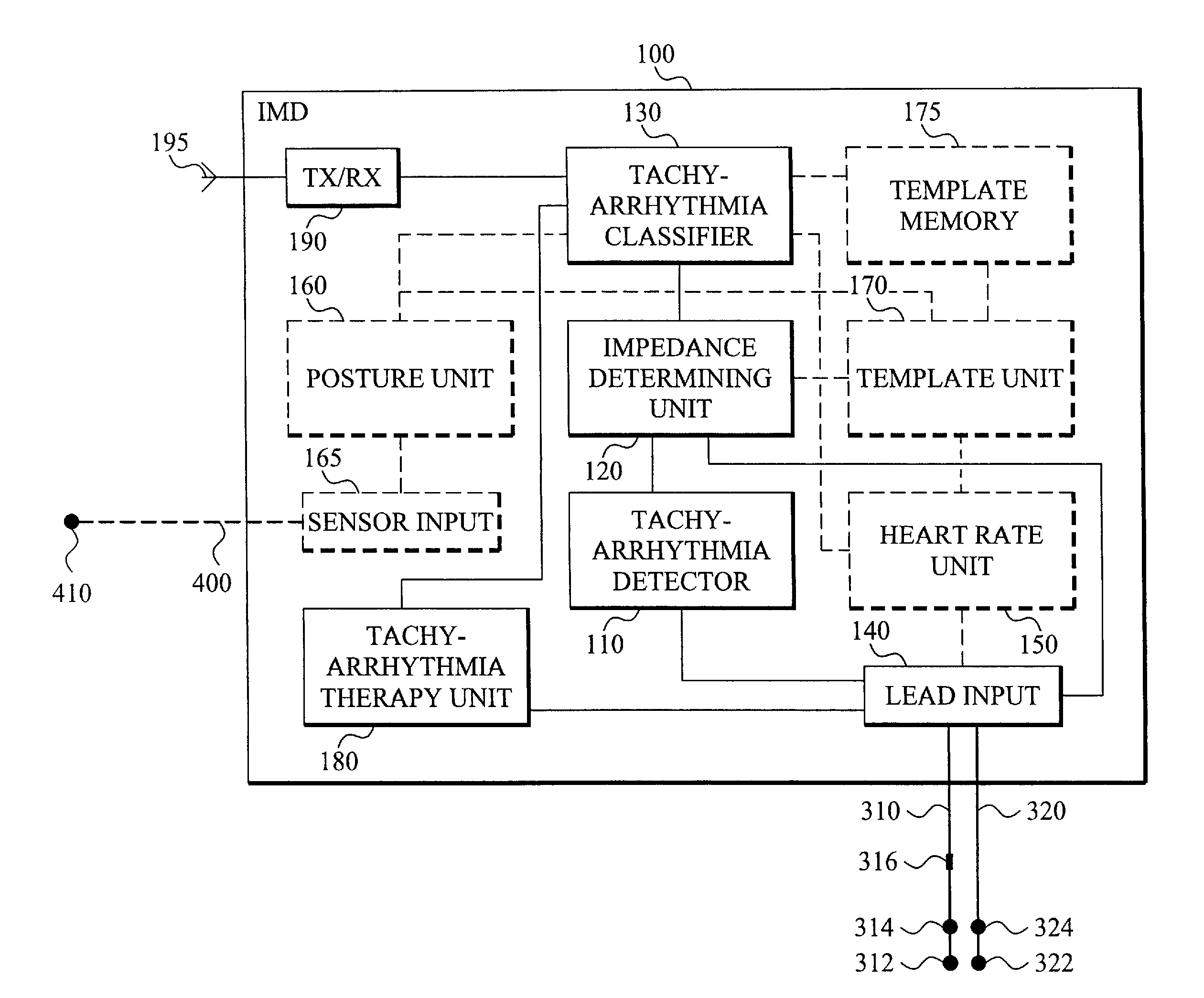 Implantable medical device and a method comprising means for detecting and classifying ventricular tachyarrhythmias