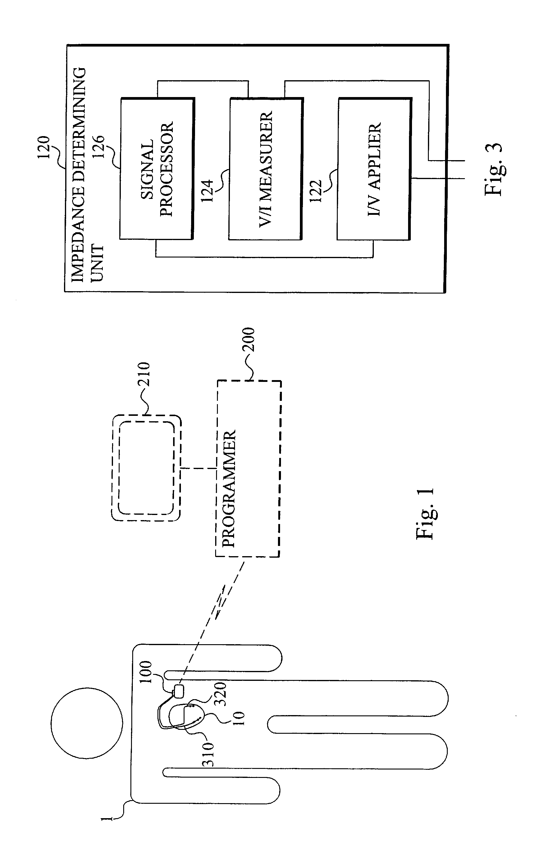 Implantable medical device and a method comprising means for detecting and classifying ventricular tachyarrhythmias