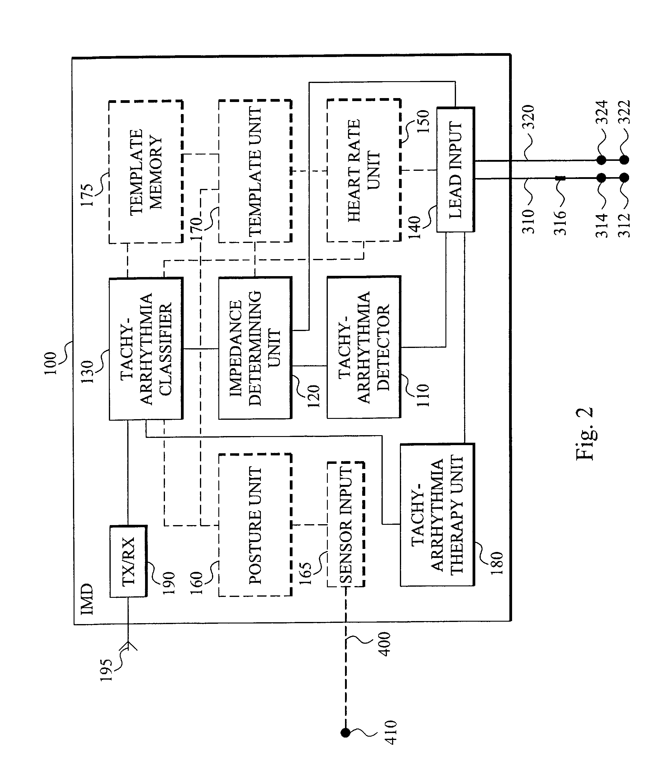 Implantable medical device and a method comprising means for detecting and classifying ventricular tachyarrhythmias