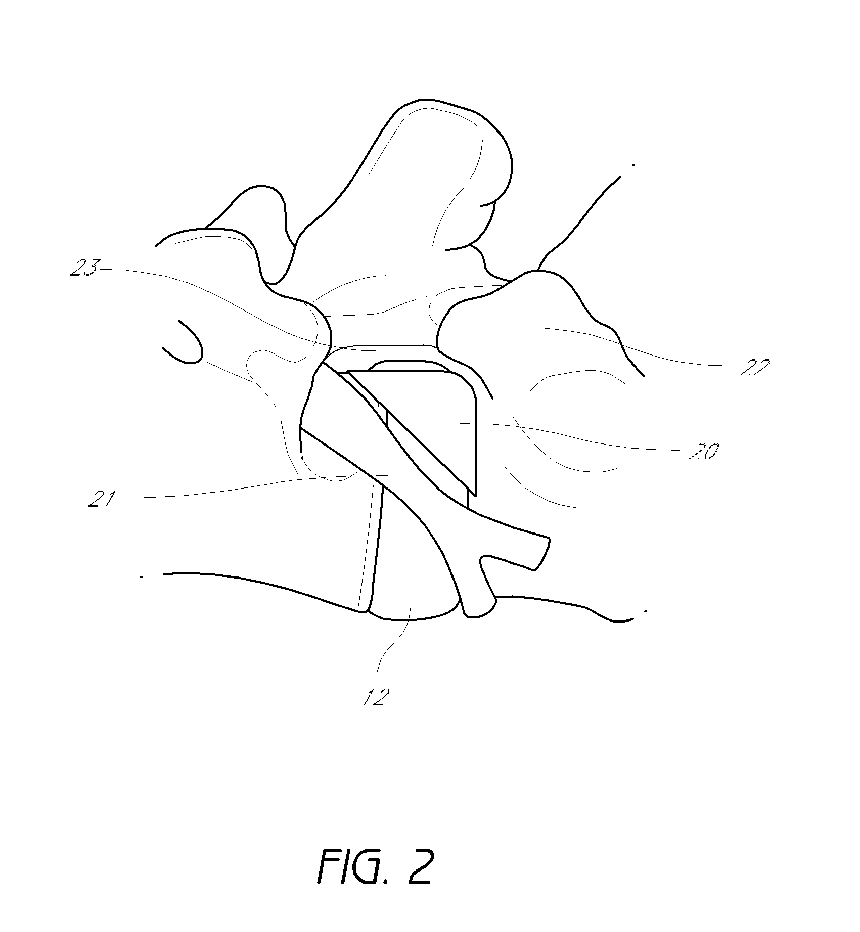 Method and apparatus for minimally invasive insertion of intervertebral implants