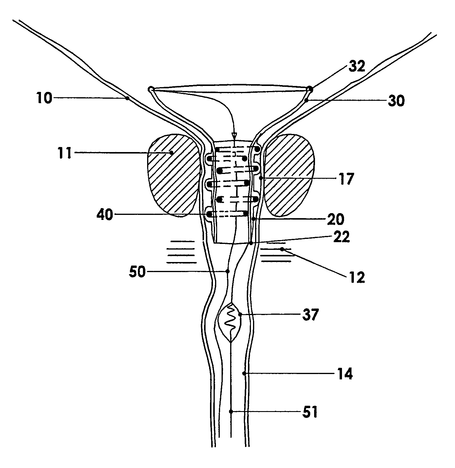 Temporary prostatic stent for benign prostatic hyperplasia