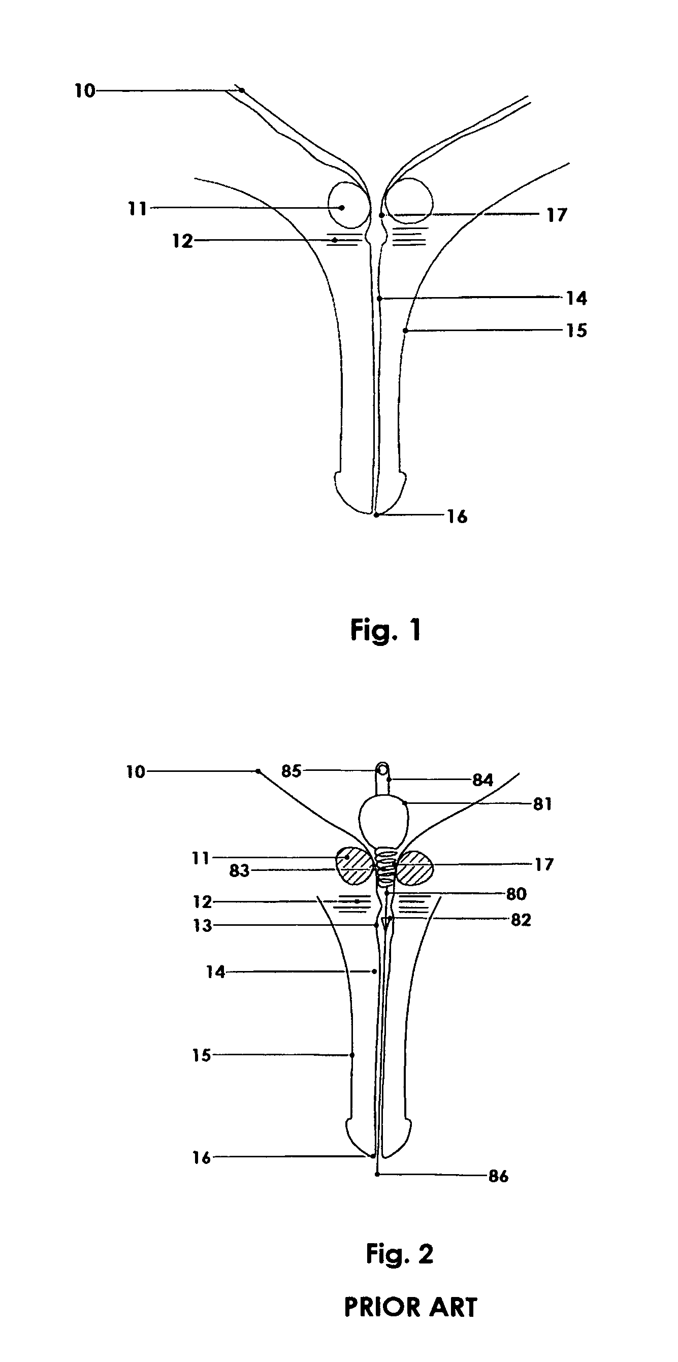 Temporary prostatic stent for benign prostatic hyperplasia